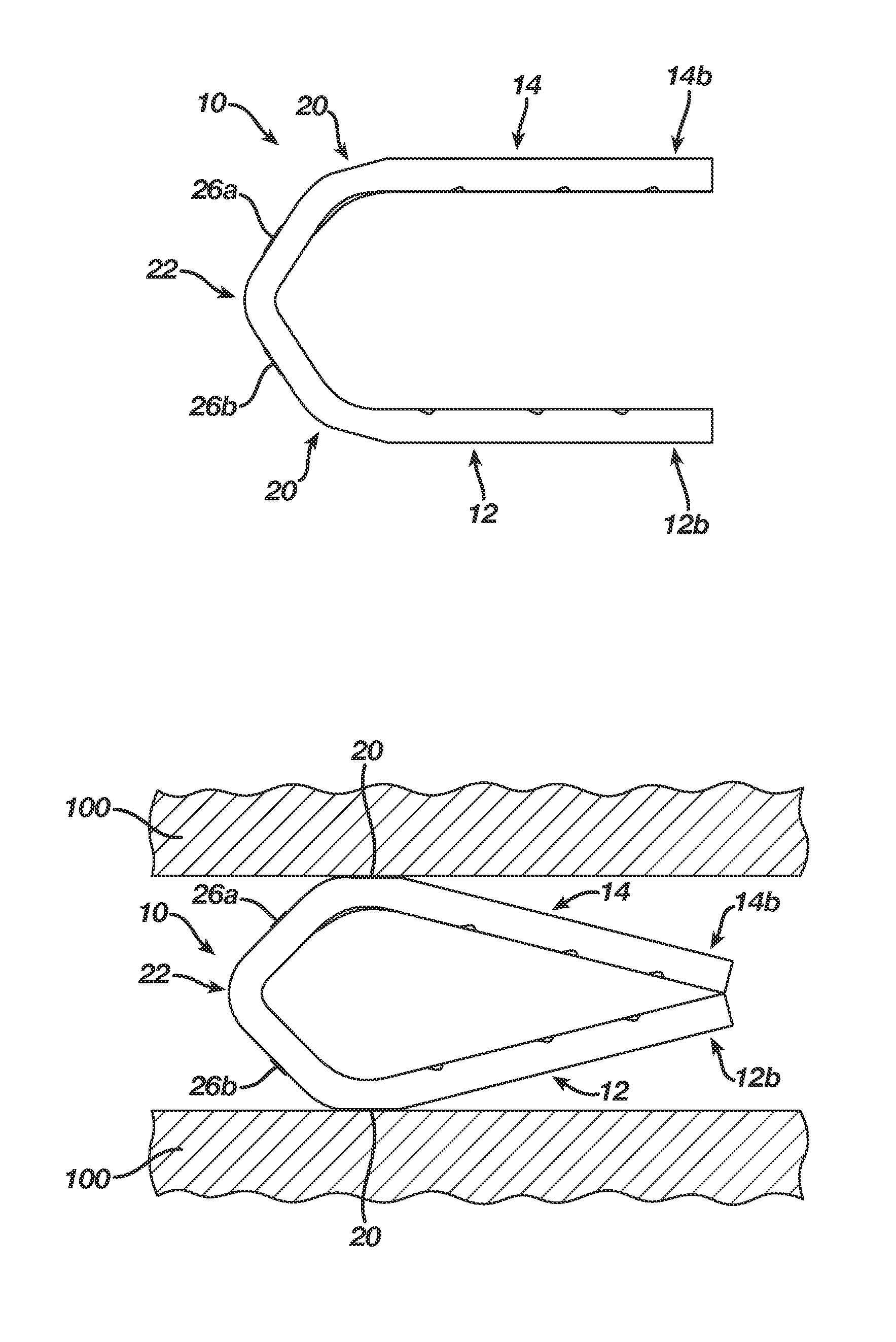 Surgical Clip Having Comliant Portion