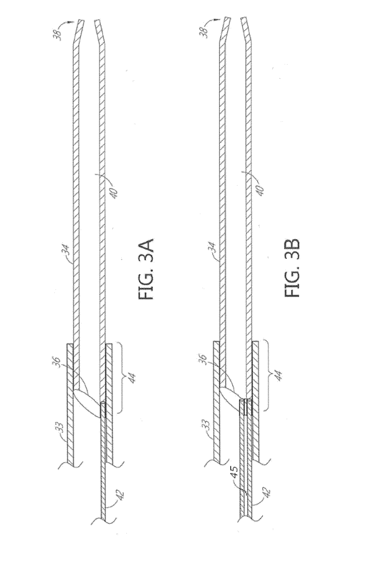 Telescoping neurovascular catheter with active distal tip