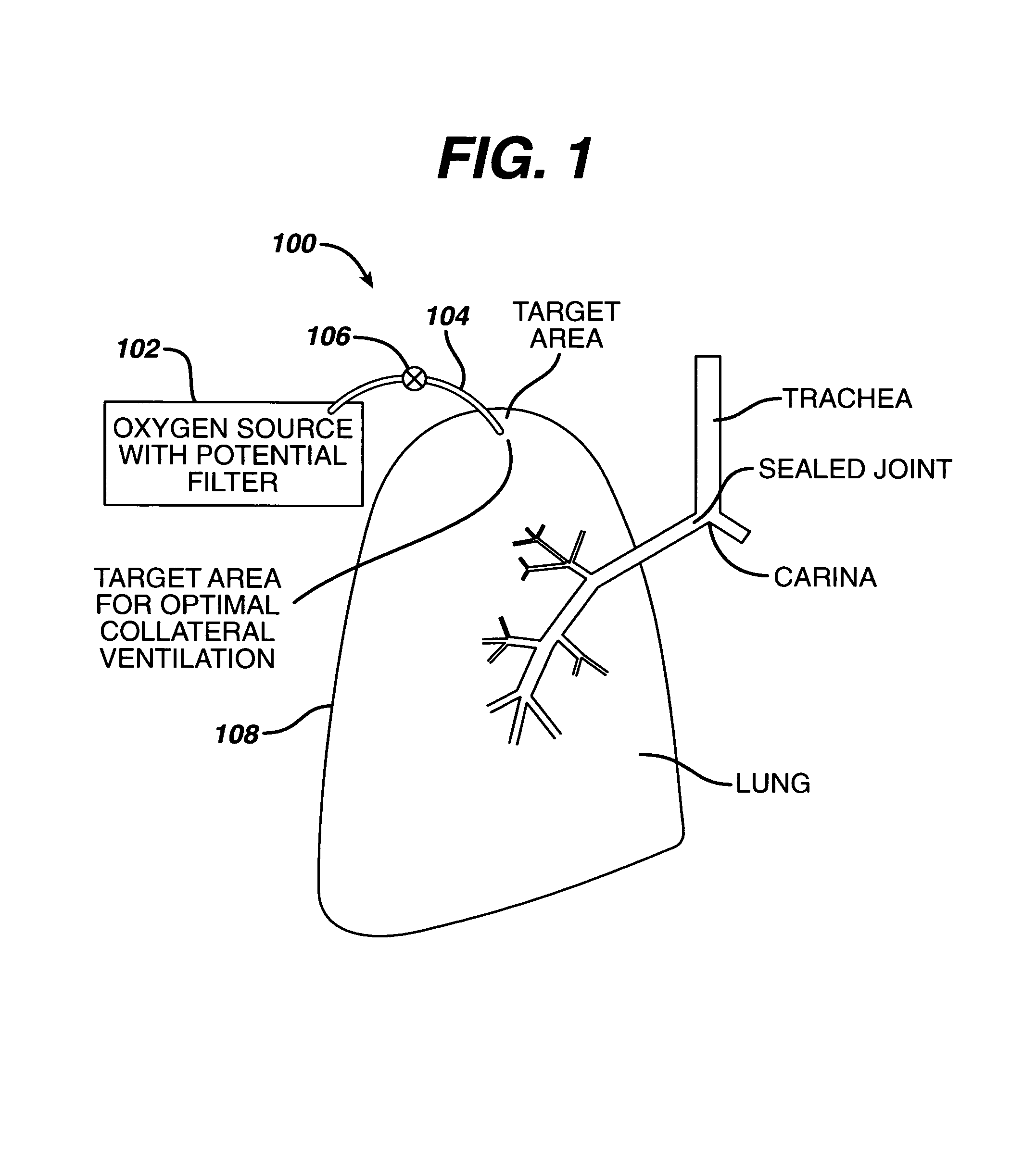 Evacuation device and method for creating a localized pleurodesis