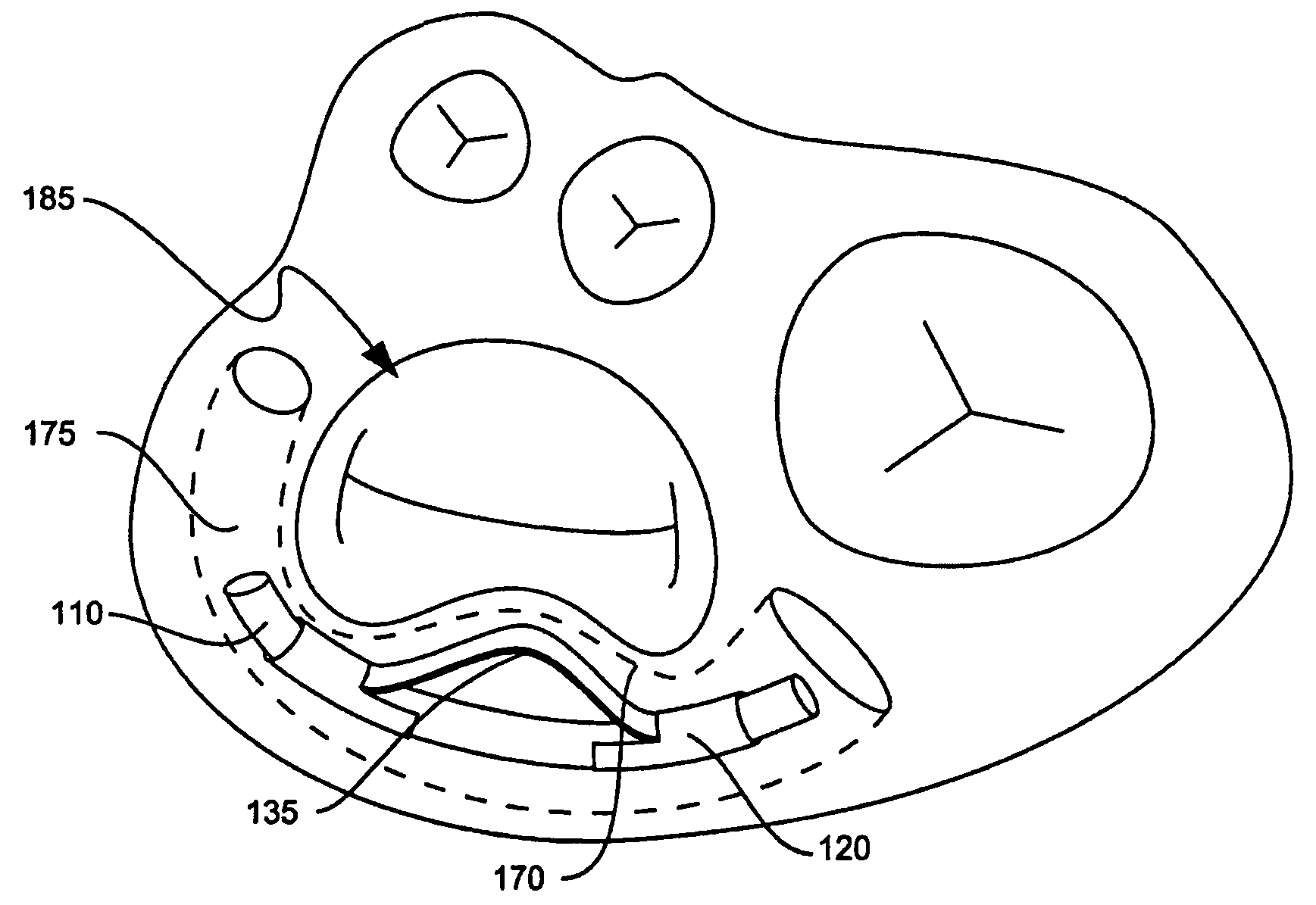 Coronary sinus approach for repair of mitral valve regurgitation