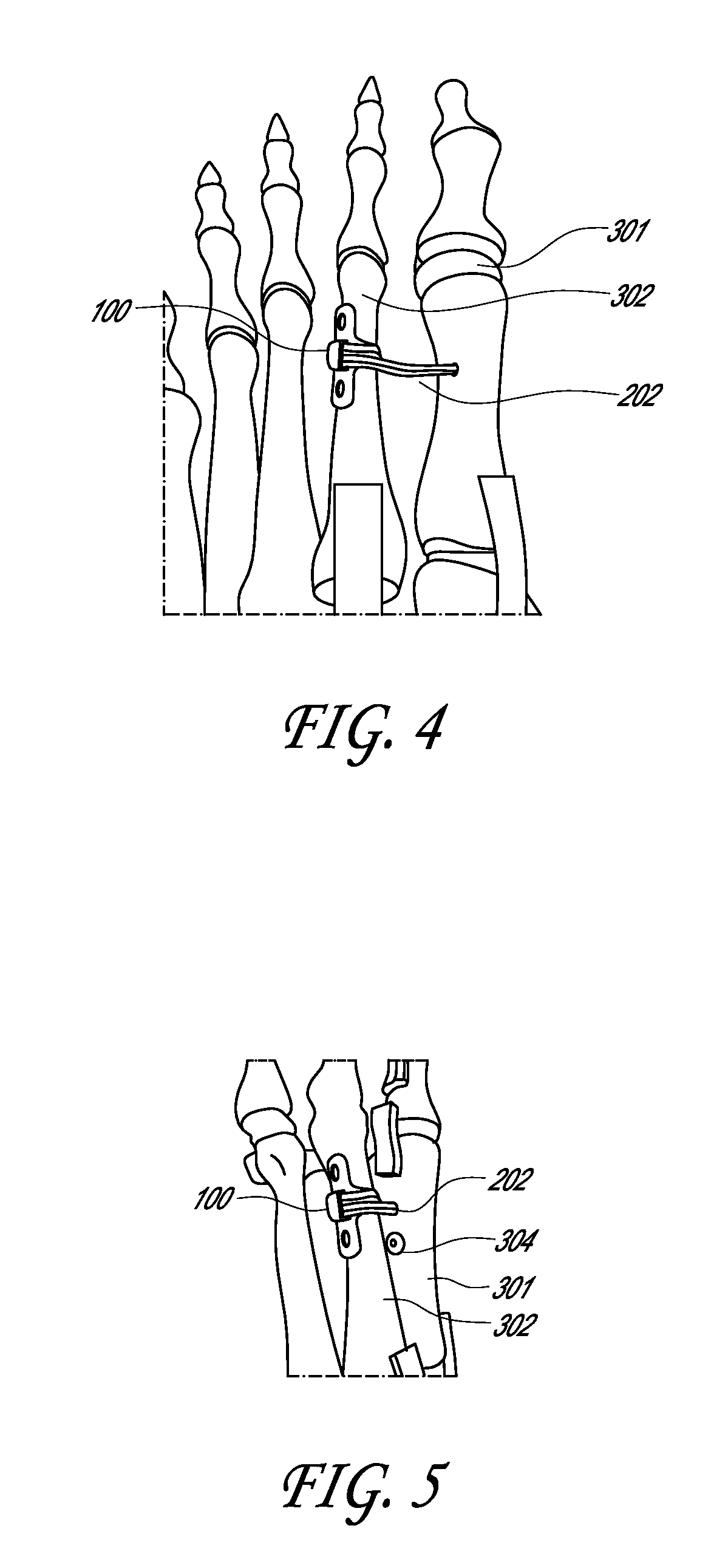 Method and device for correcting bone deformities