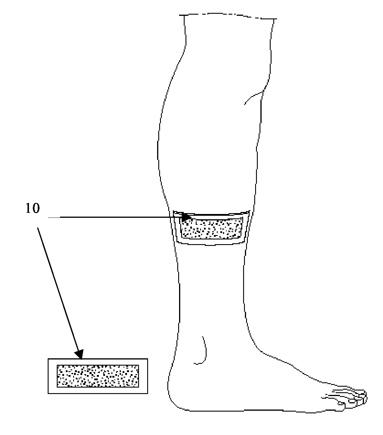 Treatment And Pre-Treatment Device, And Manufacturing Method Therefor, Involving Nitric Oxide