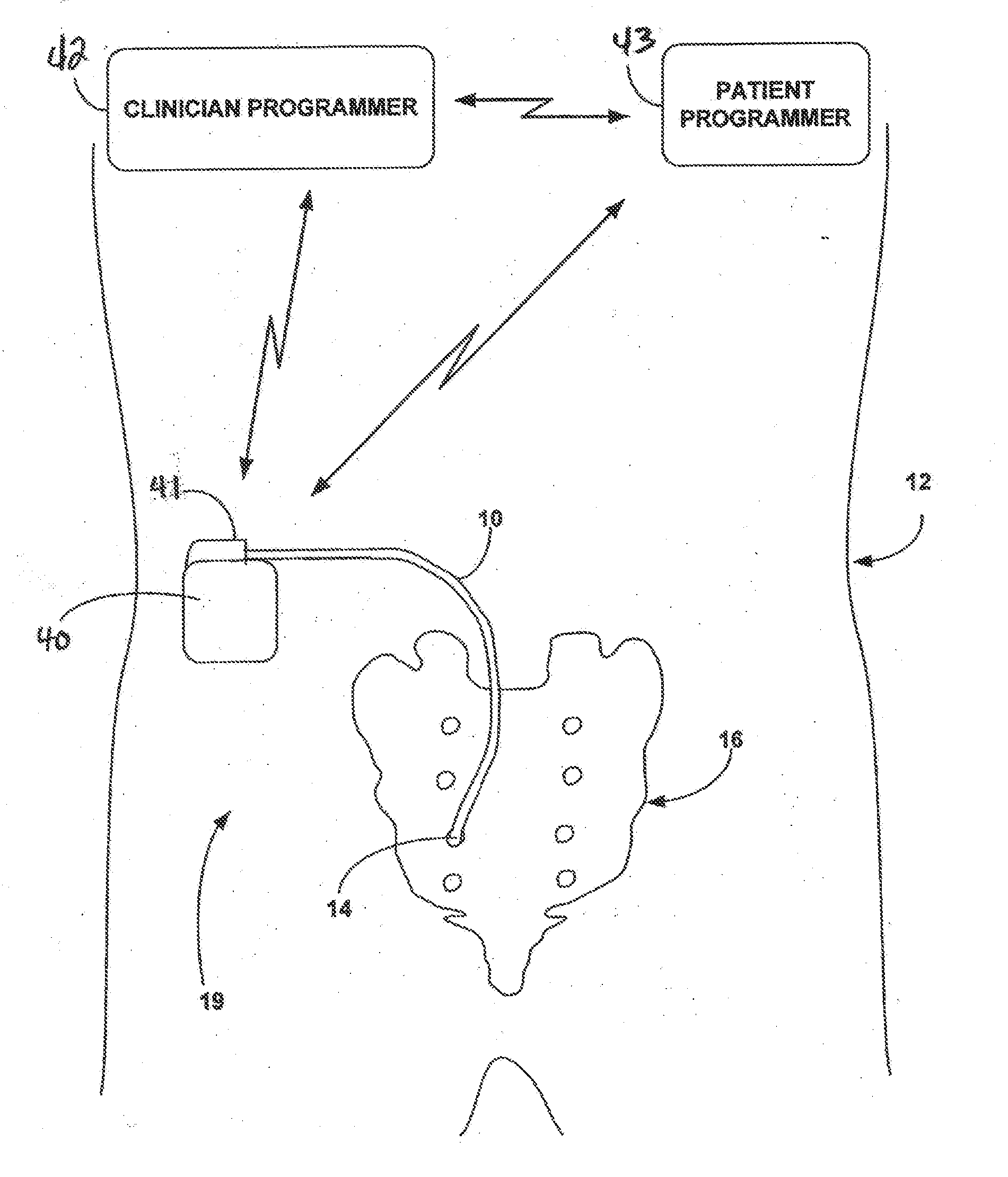 Implantable medical electrical stimulation lead fixation method and apparatus