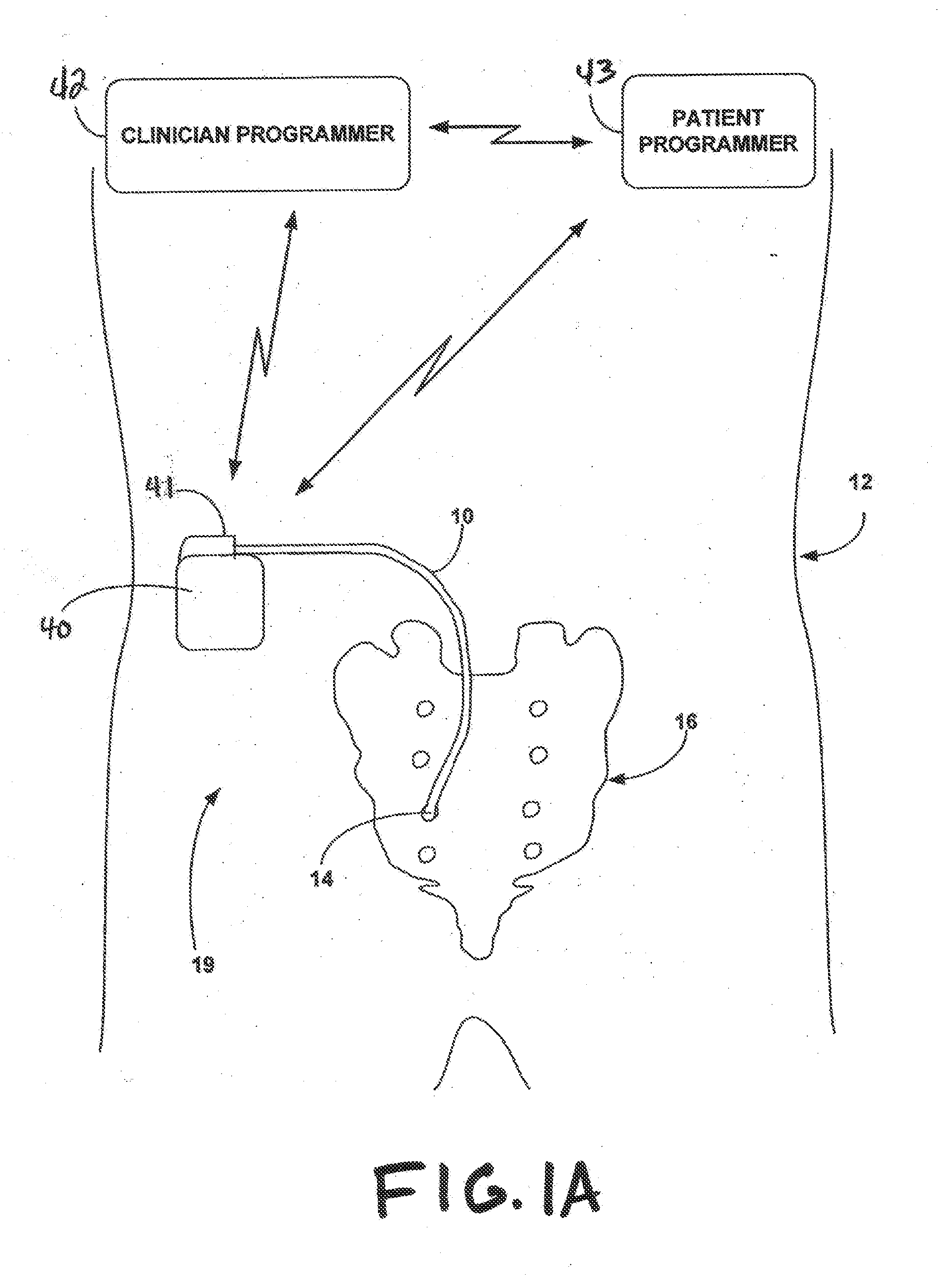 Implantable medical electrical stimulation lead fixation method and apparatus