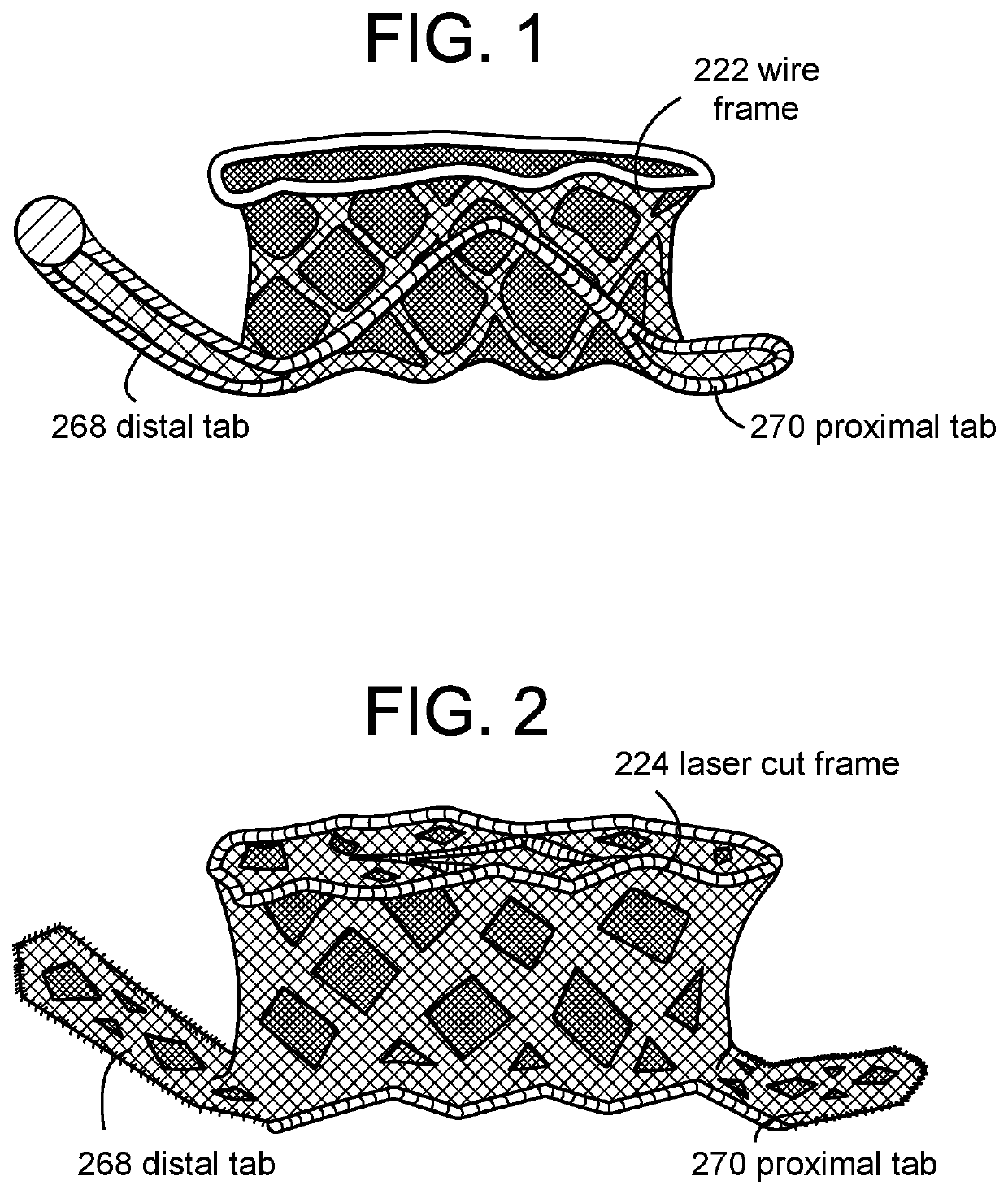 Proximal tab for side-delivered transcatheter heart valve prosthesis