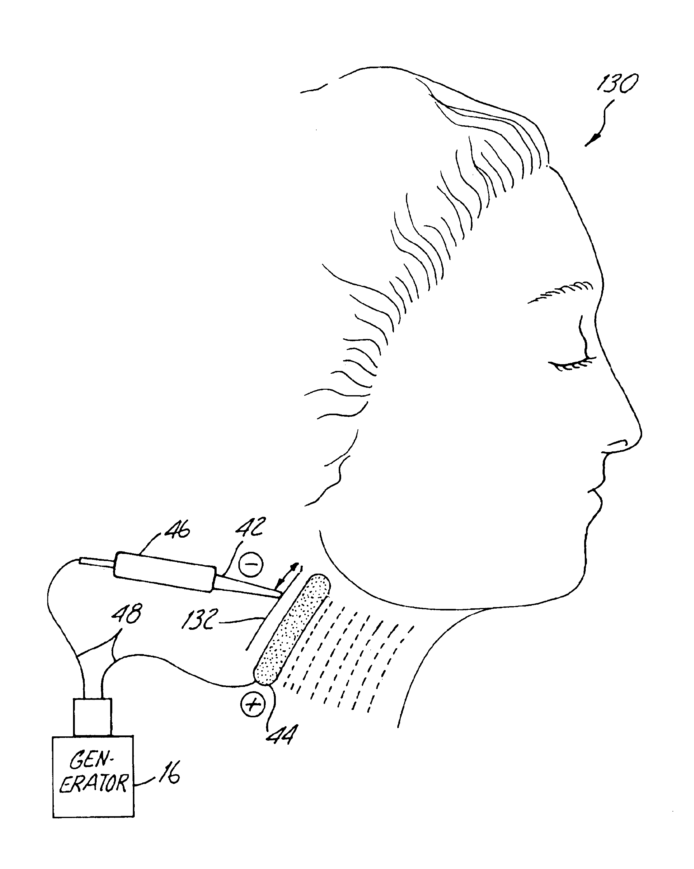 Apparatus and method for reducing subcutaneous fat deposits, virtual face lift and body sculpturing by electroporation