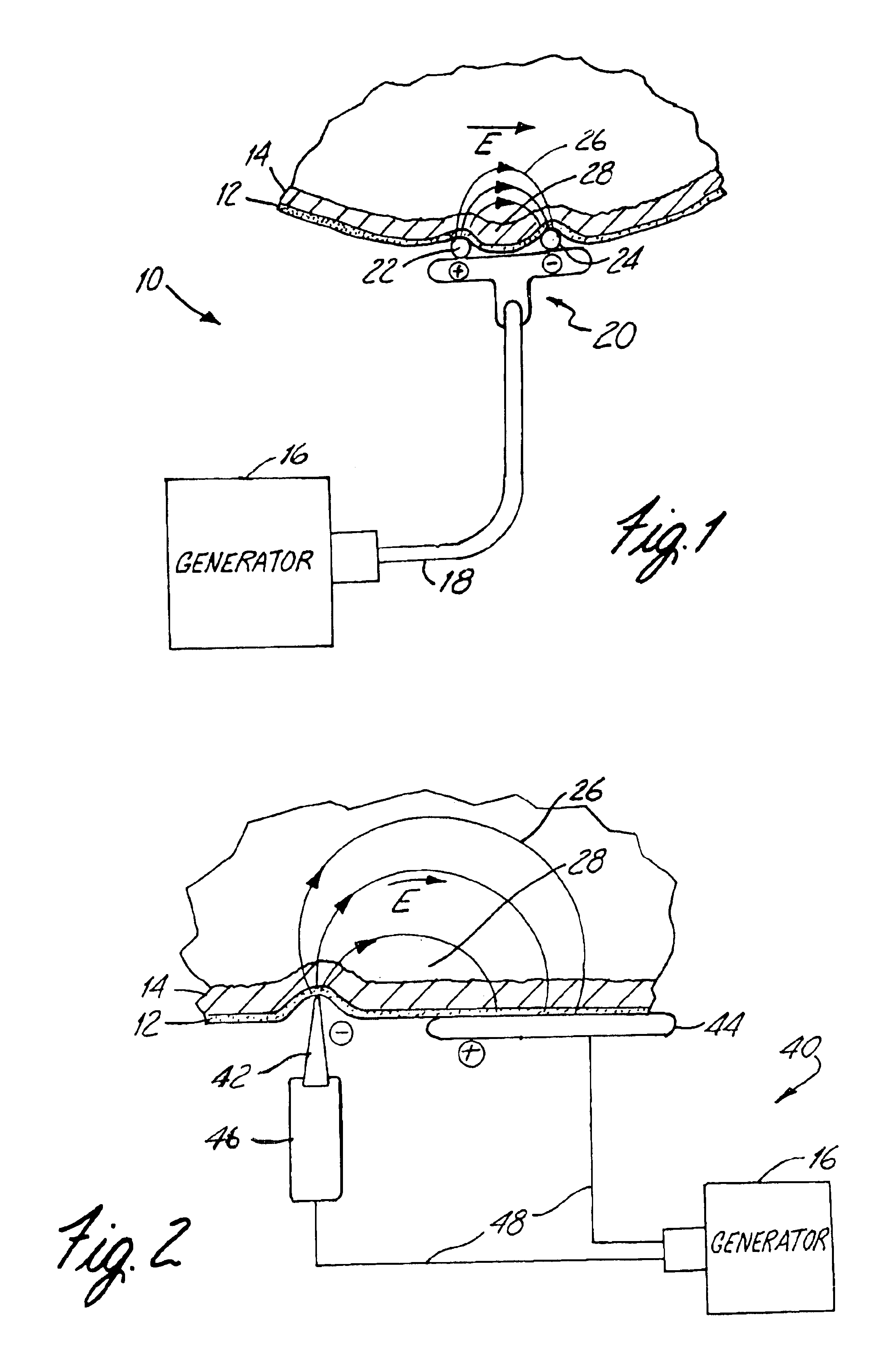 Apparatus and method for reducing subcutaneous fat deposits, virtual face lift and body sculpturing by electroporation