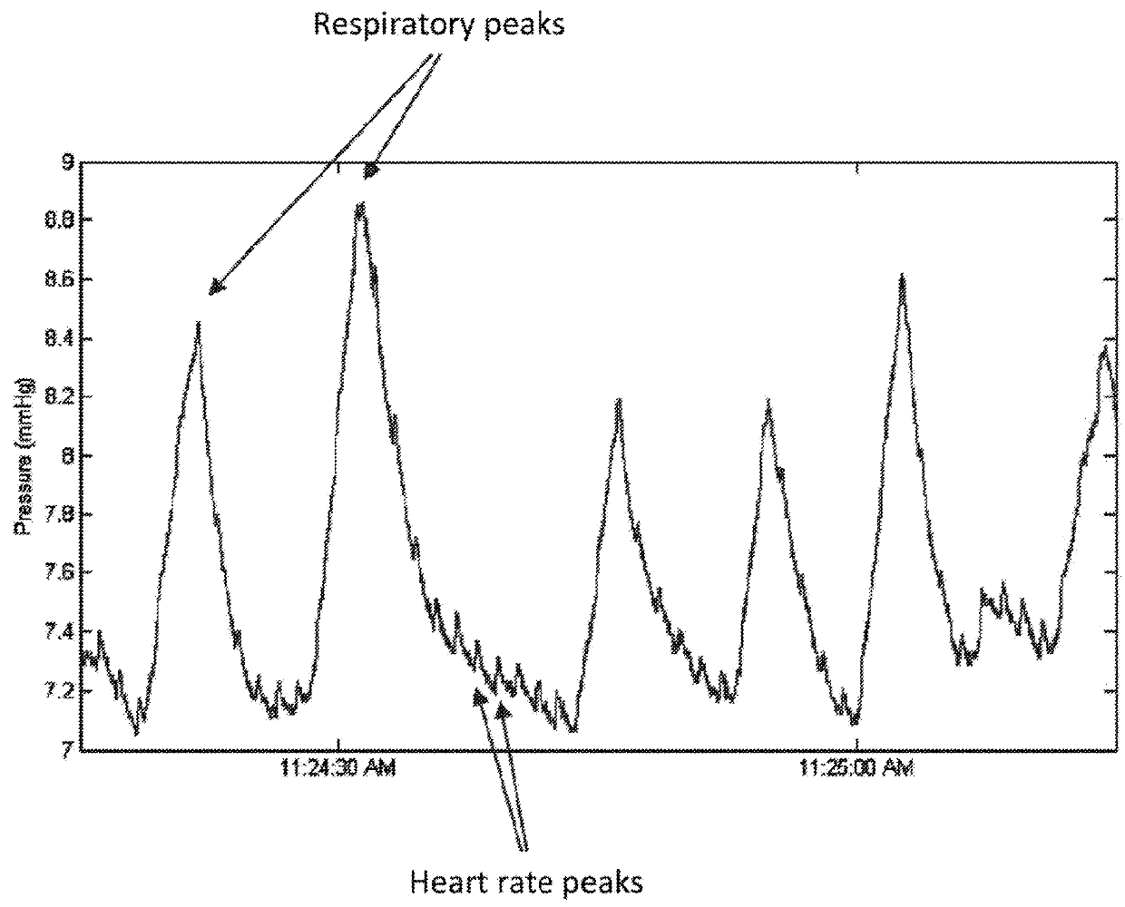 Systems, devices and methods for sensing physiologic data and draining and analyzing bodily fluids