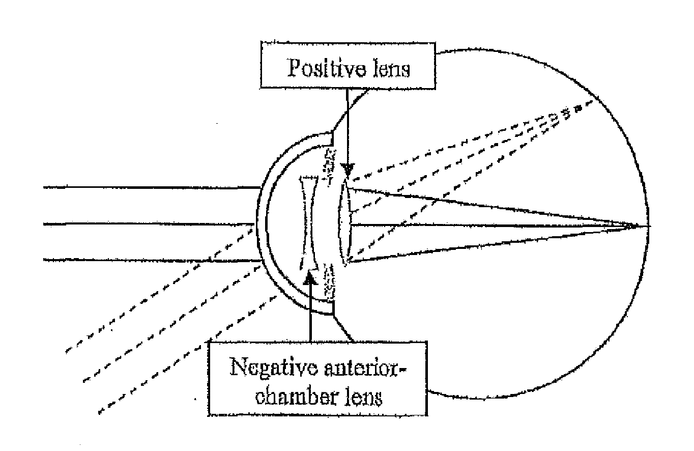 Intraocular lens that matches an image surface to a retinal shape, and method of designing same