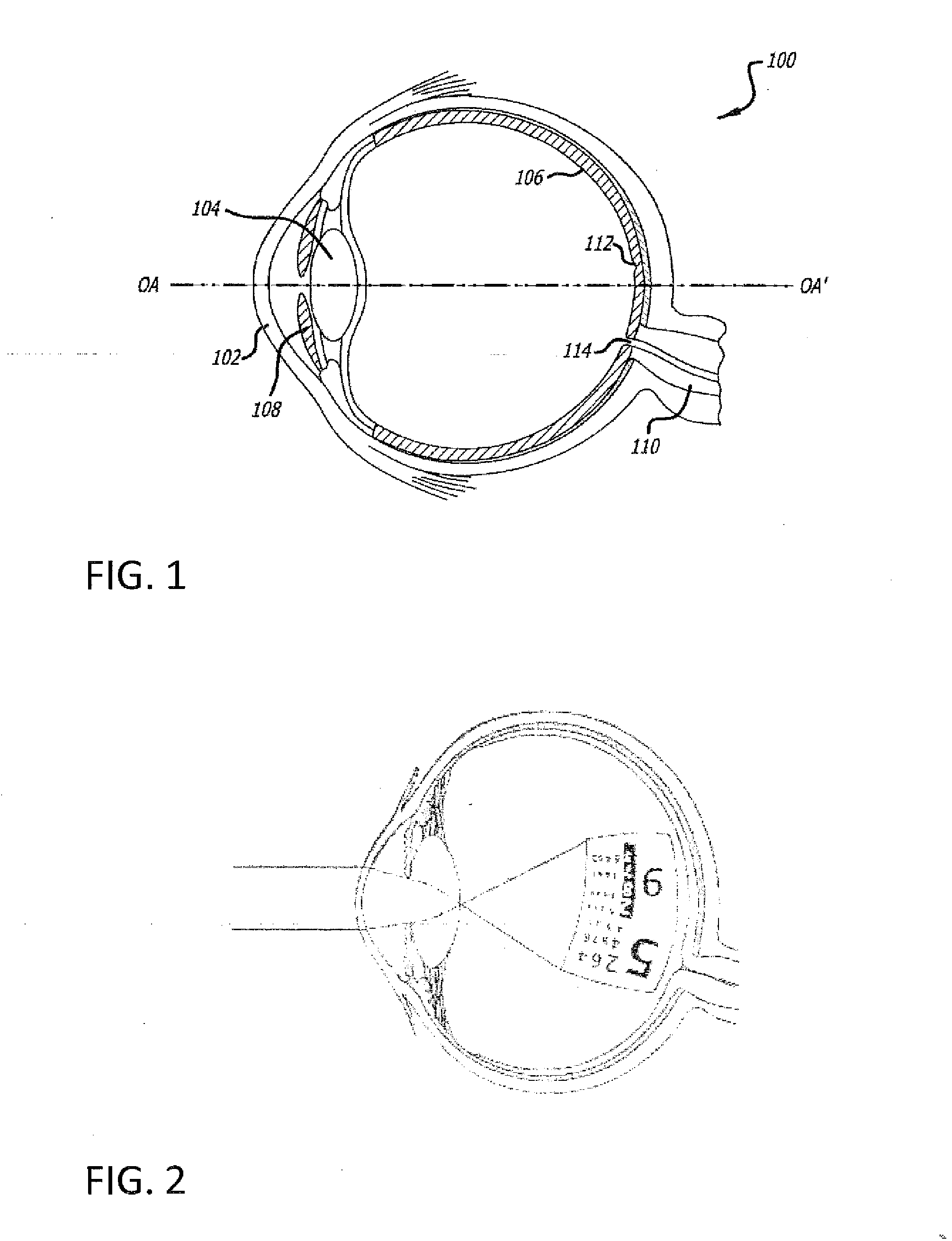 Intraocular lens that matches an image surface to a retinal shape, and method of designing same