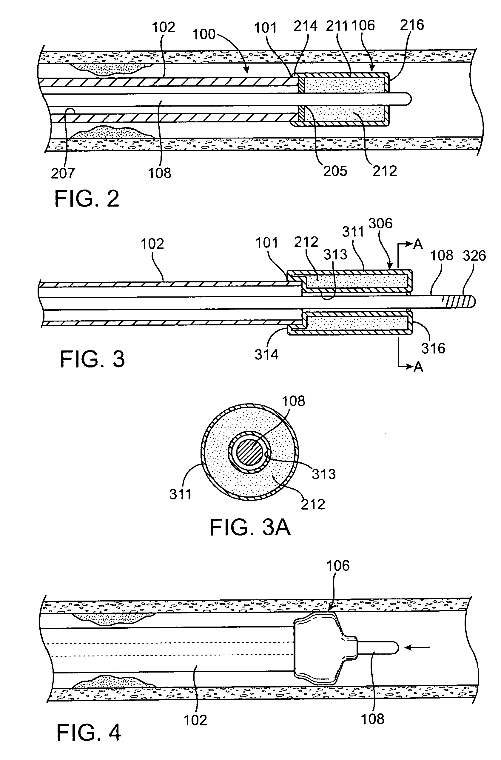 Device with actuatable fluid-column occluder for prevention of embolization