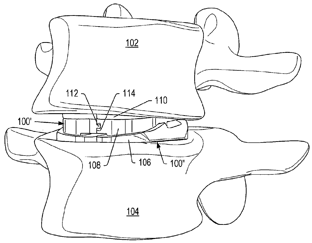 Posterior stabilization system with isolated, dual dampener systems