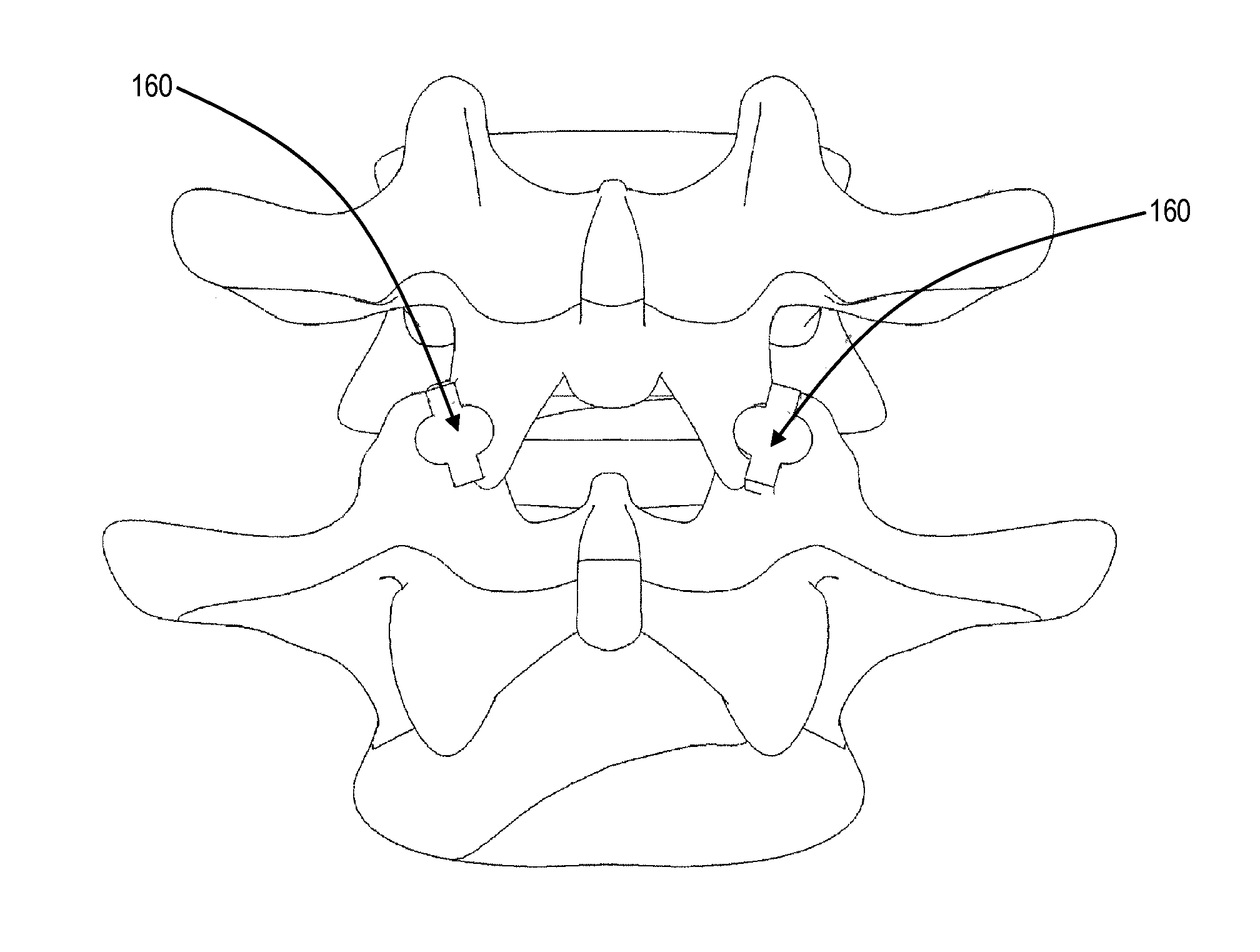 Facet distraction device, facet joint implant, and associated methods