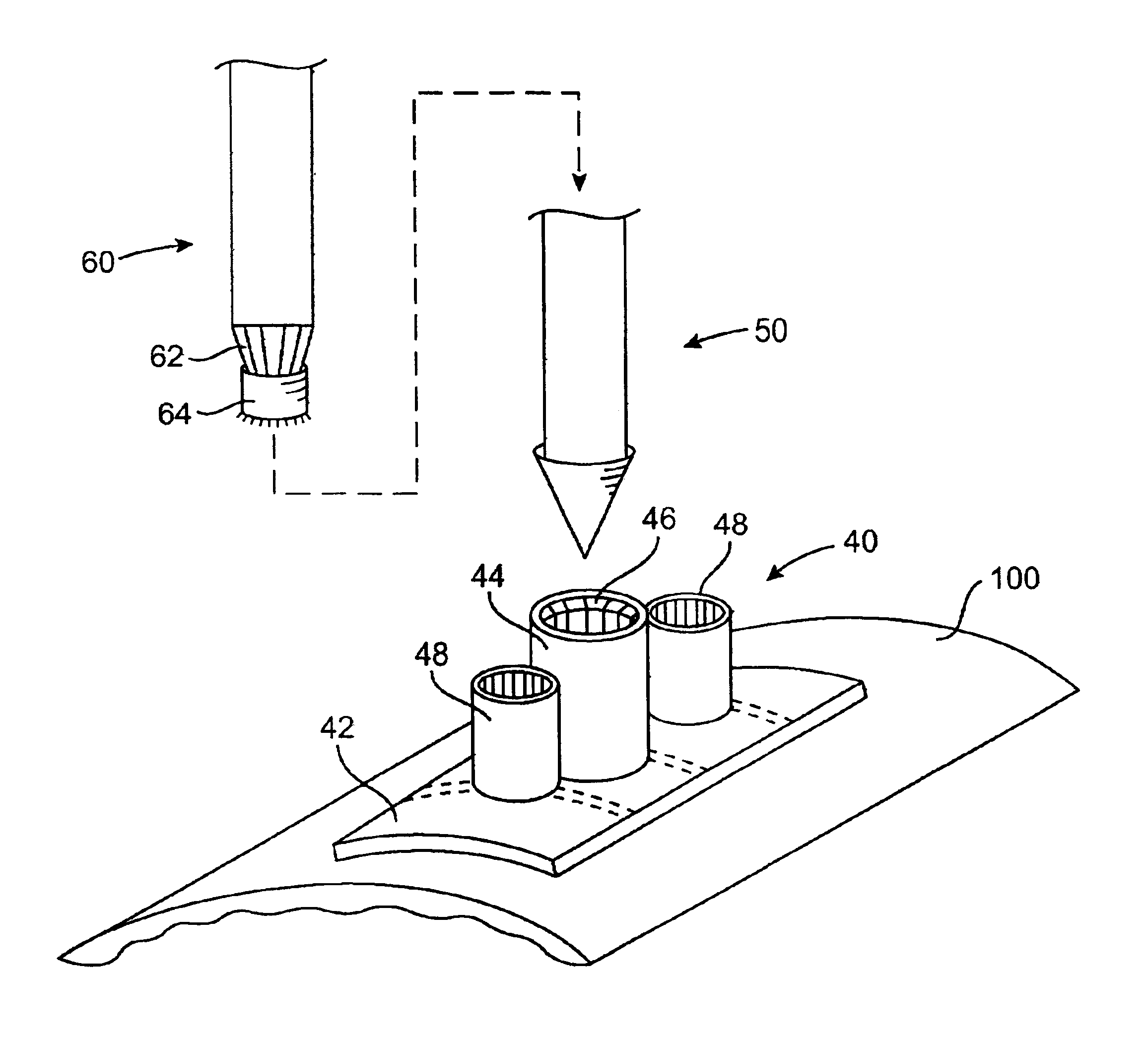 Access port system for anastomosis