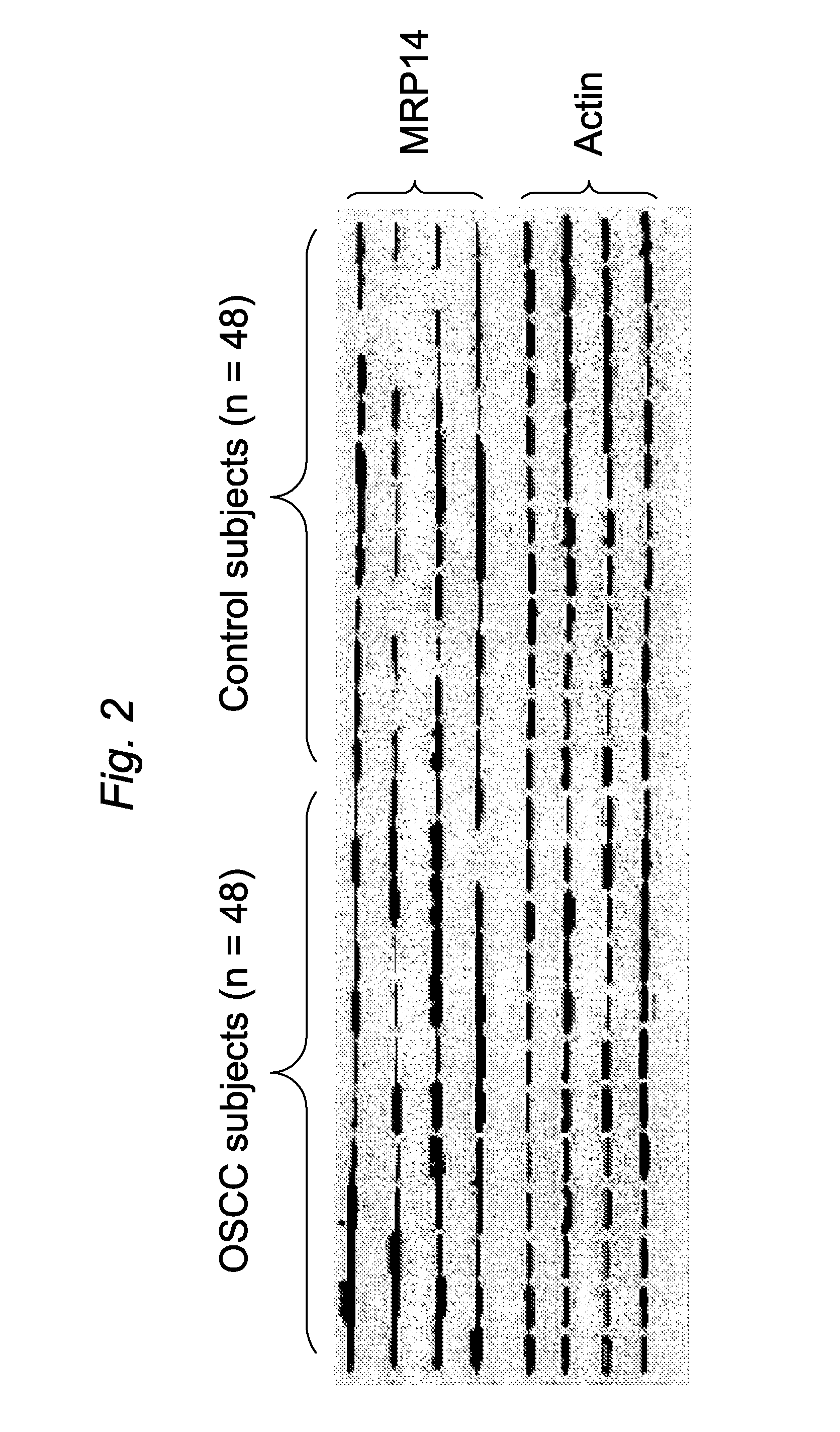 Salivary protein biomarkers for human oral cancer