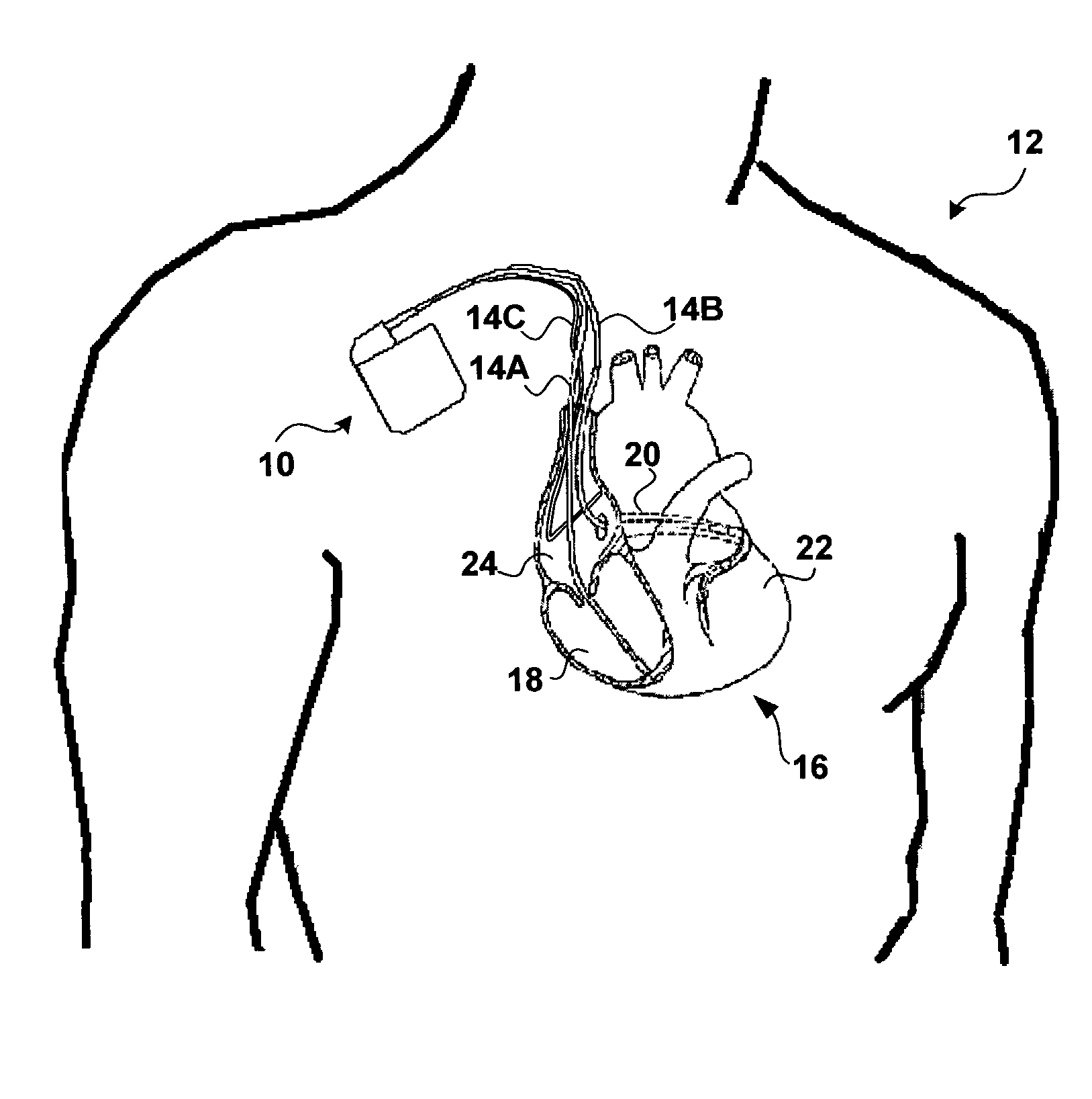 Monitoring QRS complex to identify left ventricular dysfunction