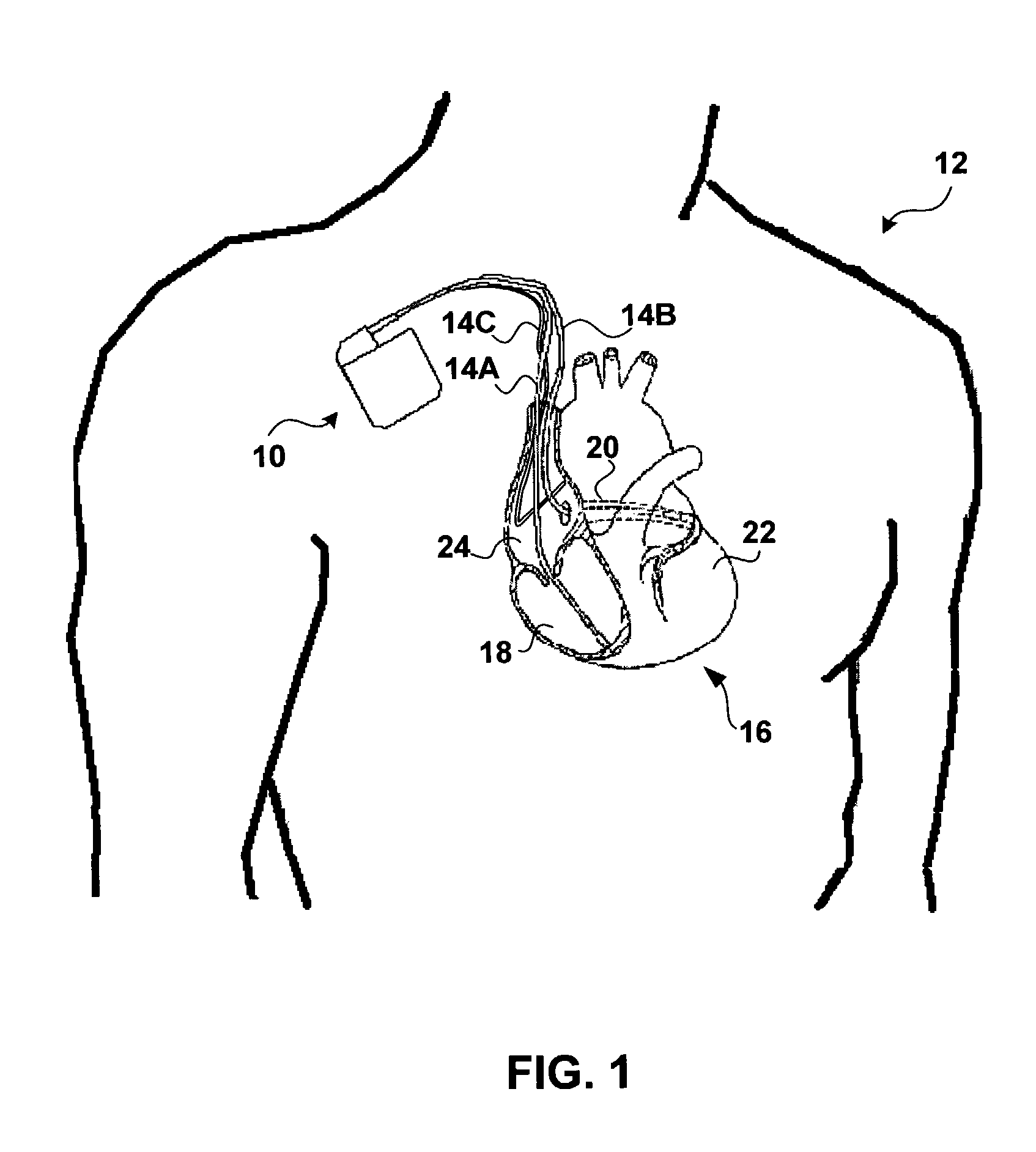 Monitoring QRS complex to identify left ventricular dysfunction