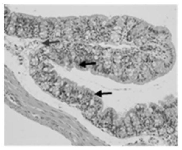 Application of Shengjiang Xiexin Decoction in the Treatment of Diarrhea Caused by Clostridium difficile Infection