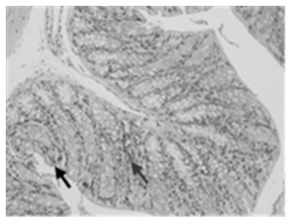 Application of Shengjiang Xiexin Decoction in the Treatment of Diarrhea Caused by Clostridium difficile Infection