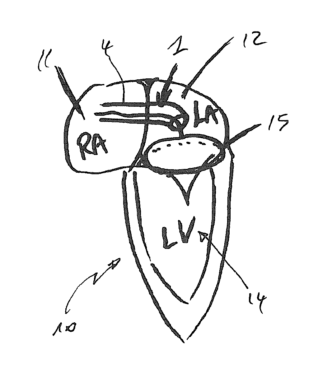 Device and method for reducing cardiac valve regurgitation