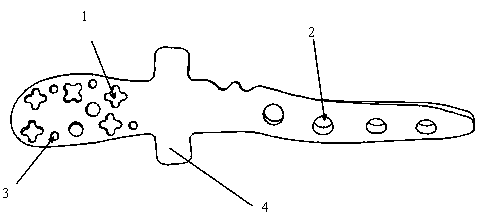 Encircling bone bonding plate for fibula distal-end B-type fracture