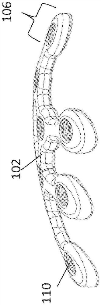 Patella Fracture Reduction Plate