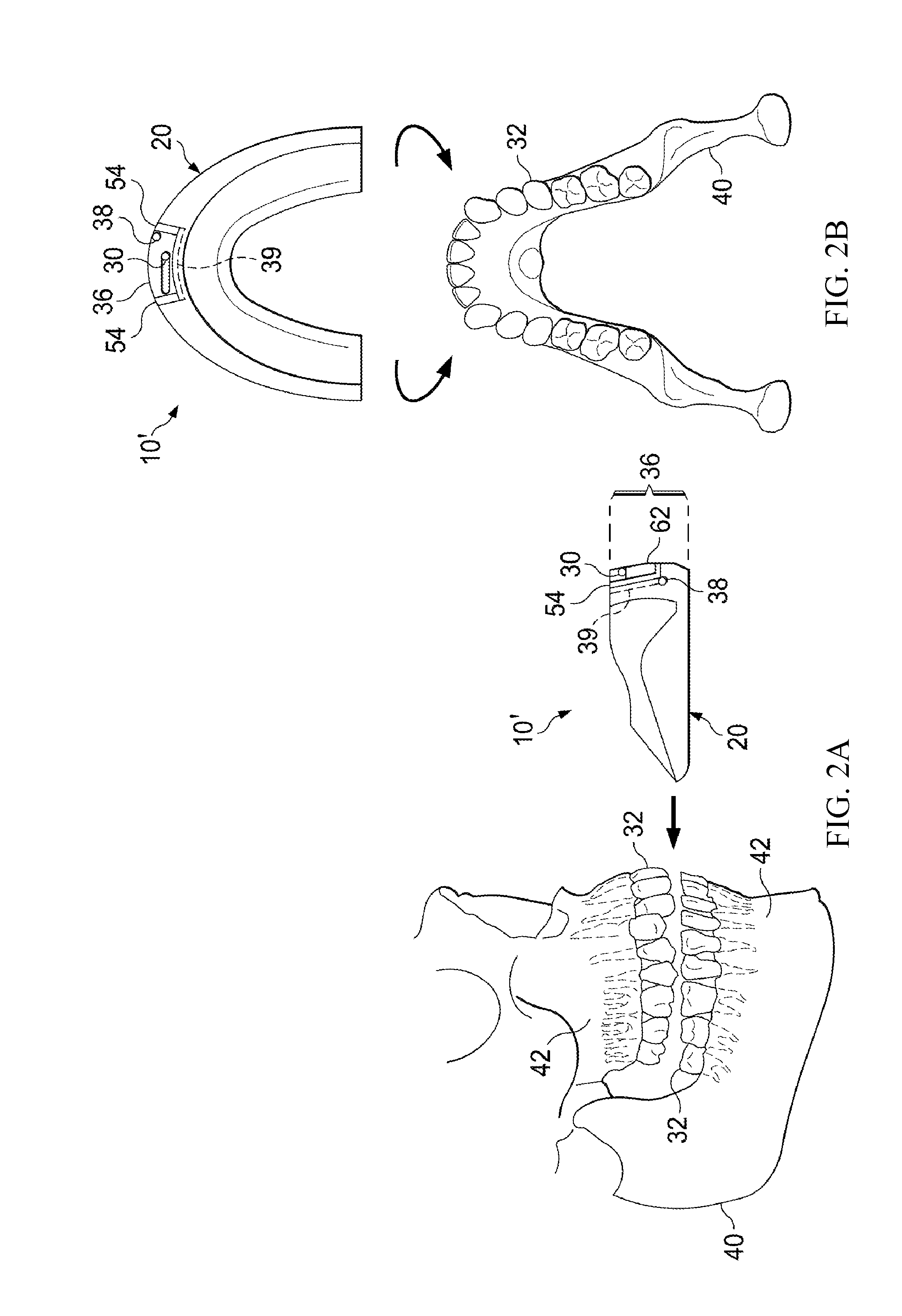 Vibrating orthodontic remodeling device and method thereof