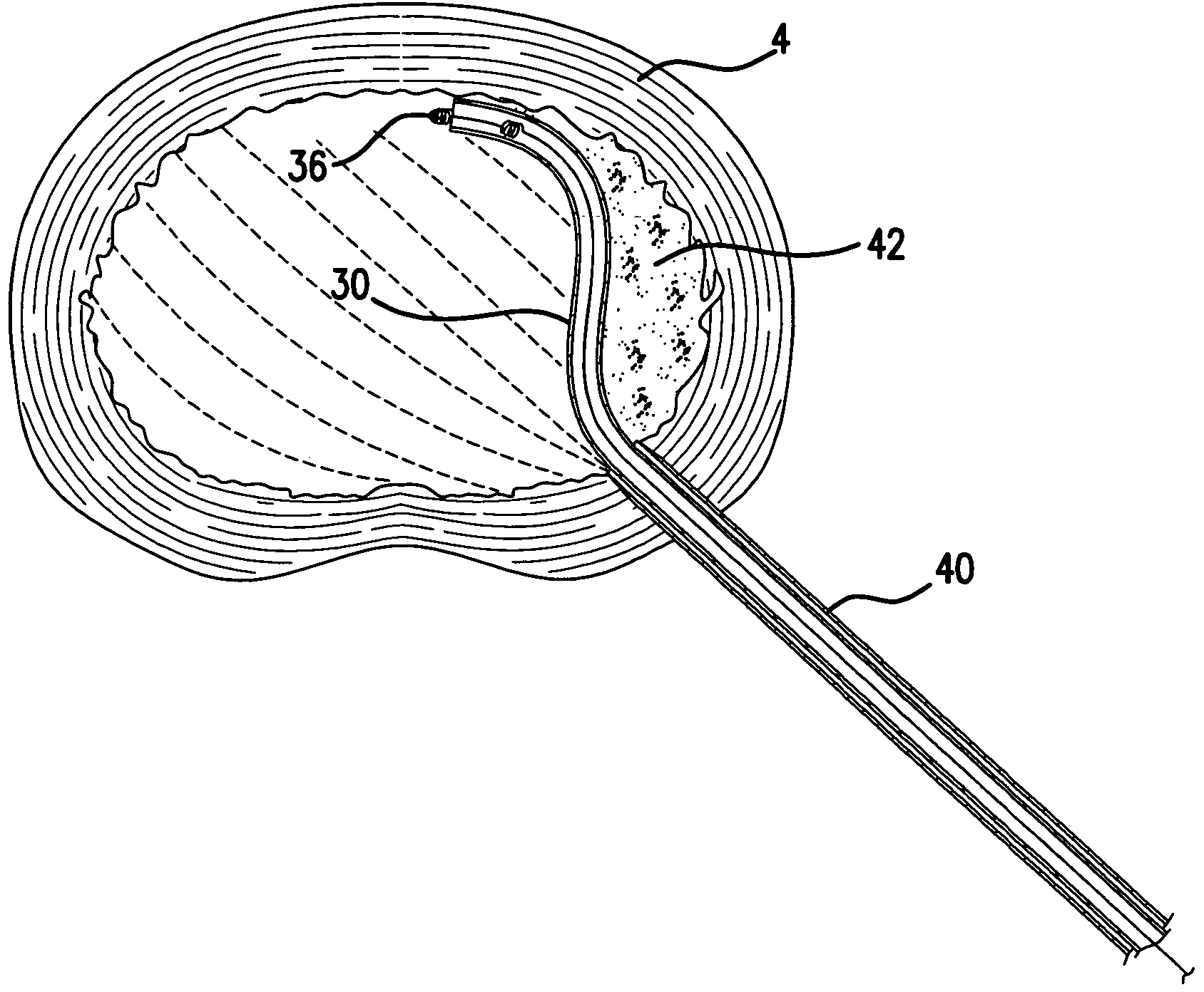 Device and method for treatment of intervertebral disc disruption