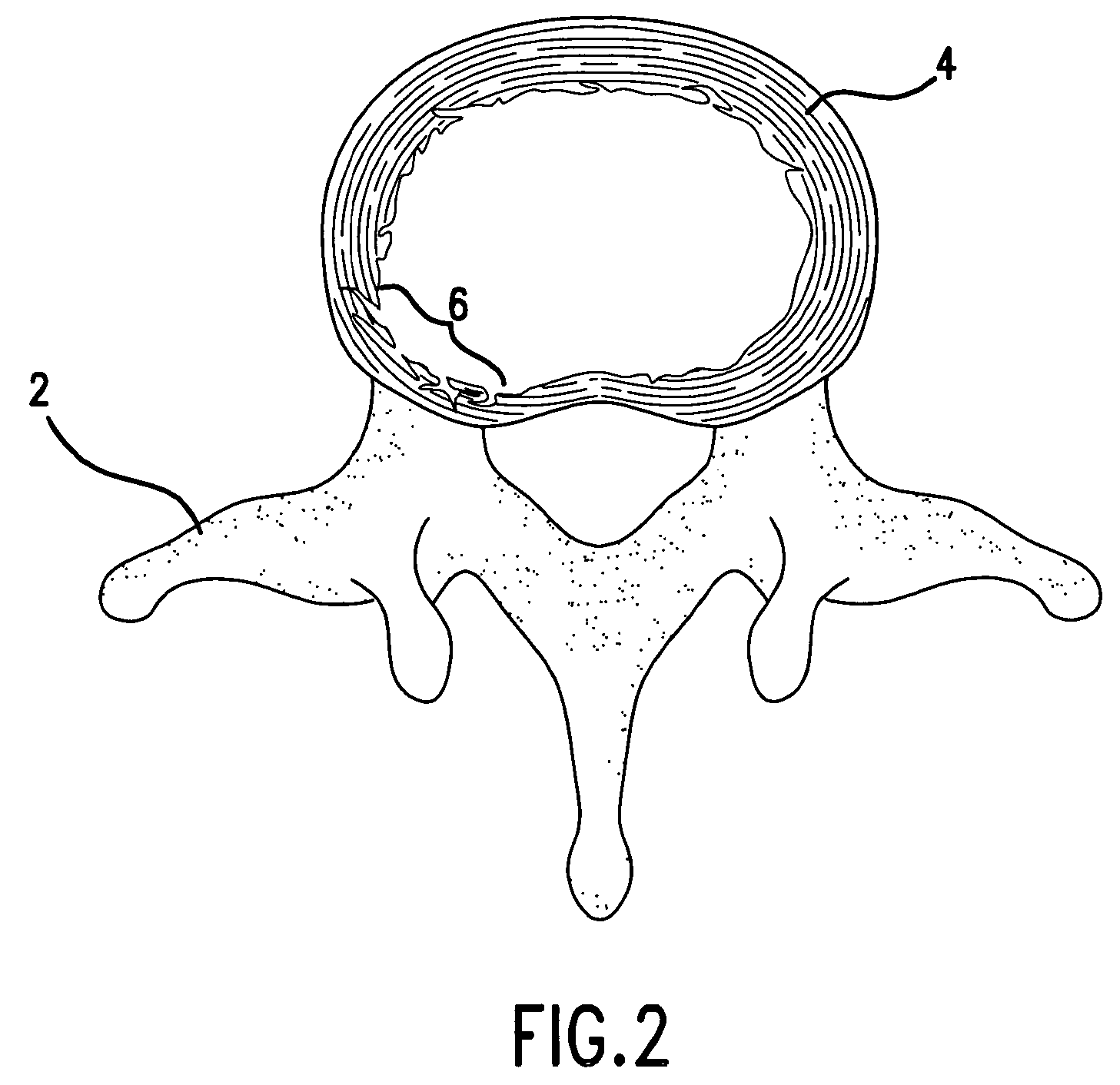 Device and method for treatment of intervertebral disc disruption