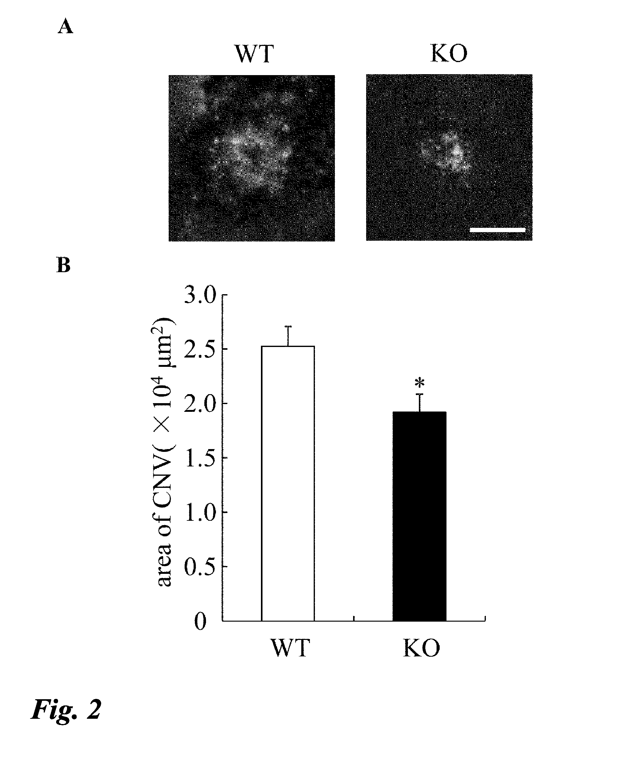 Intraocular angiogenesis inhibitor and uses thereof