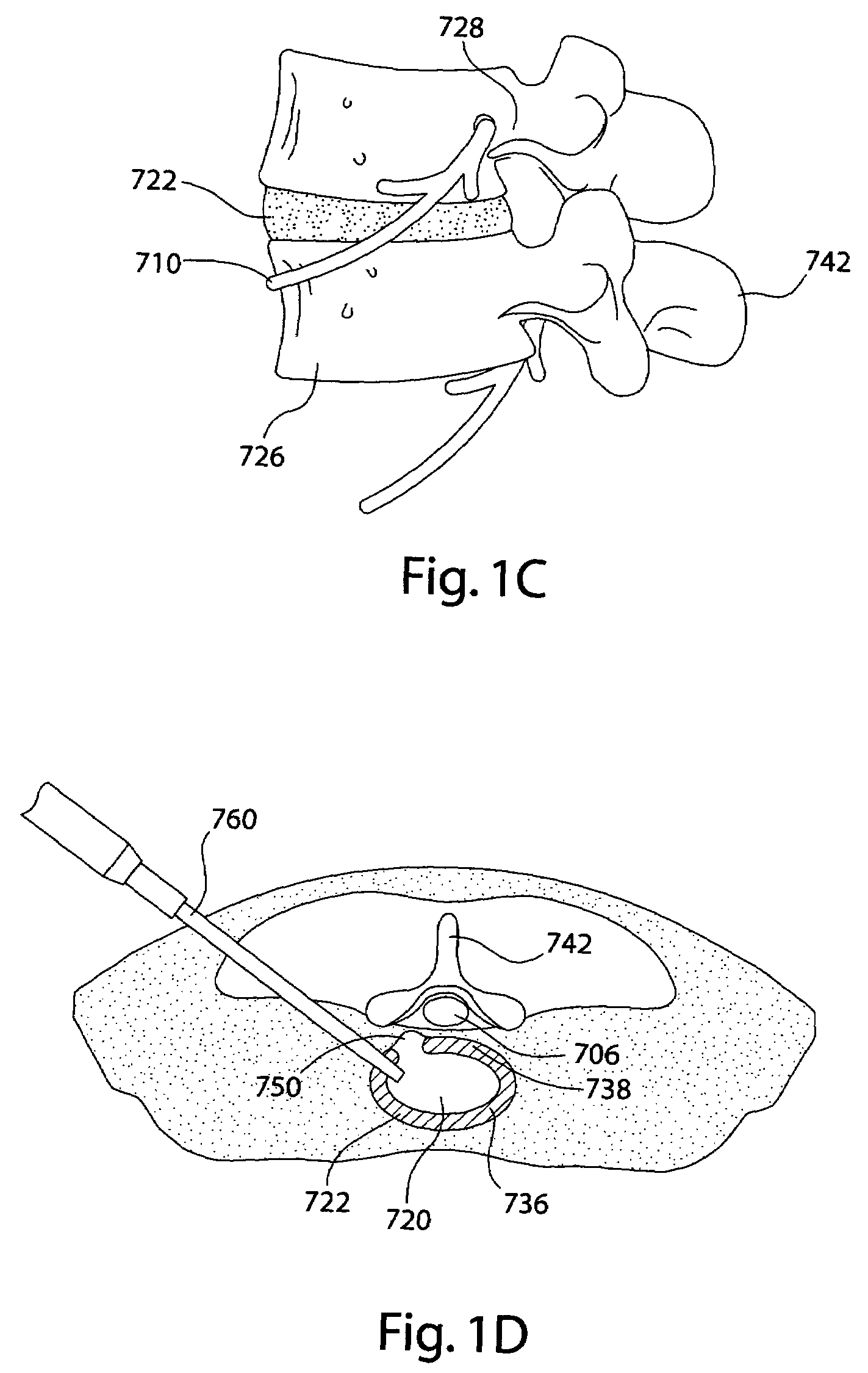 Devices and methods for spine repair