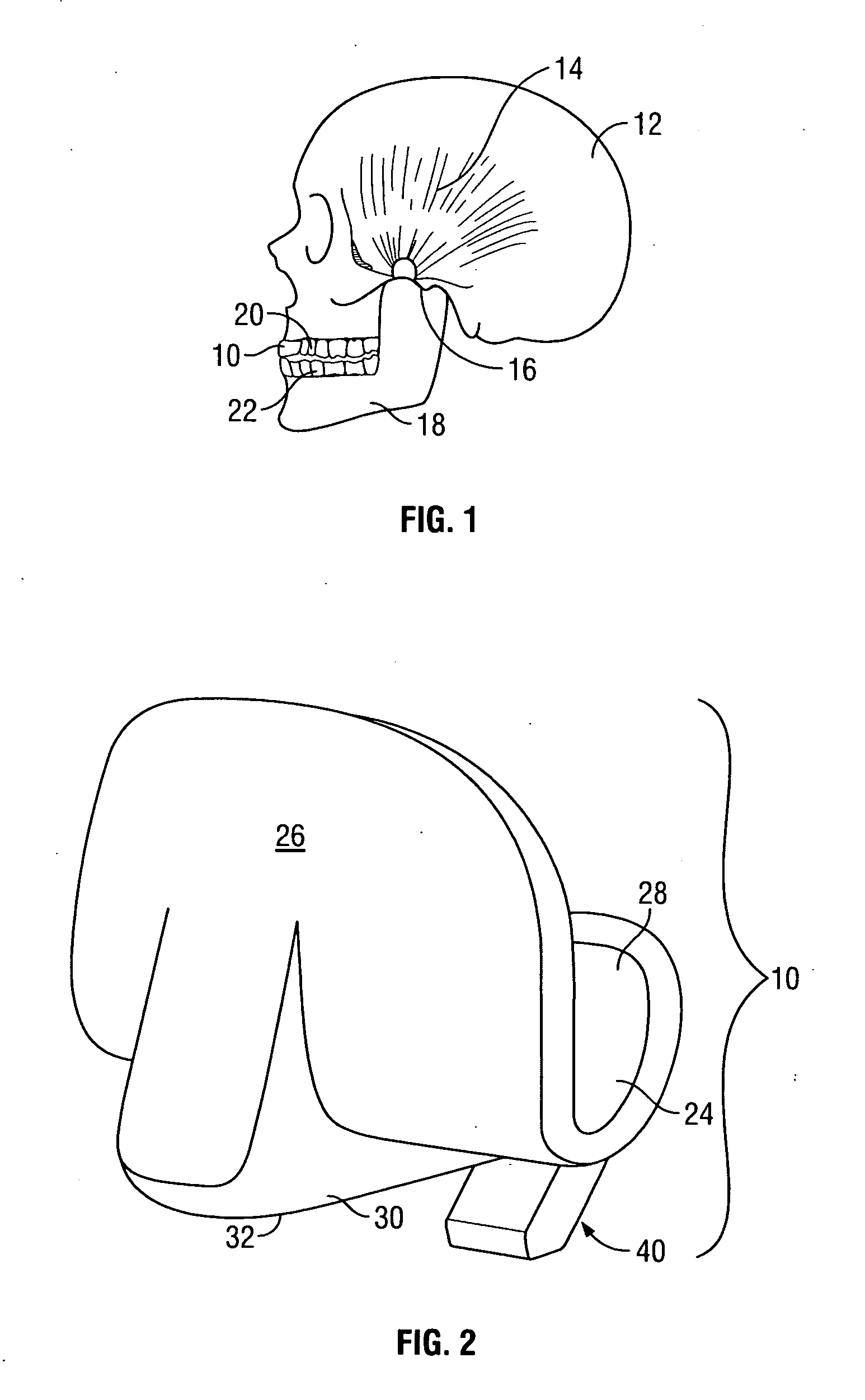 Intraoral discluder and method for relieving migraine and tension headaches and temporomandibular disorders