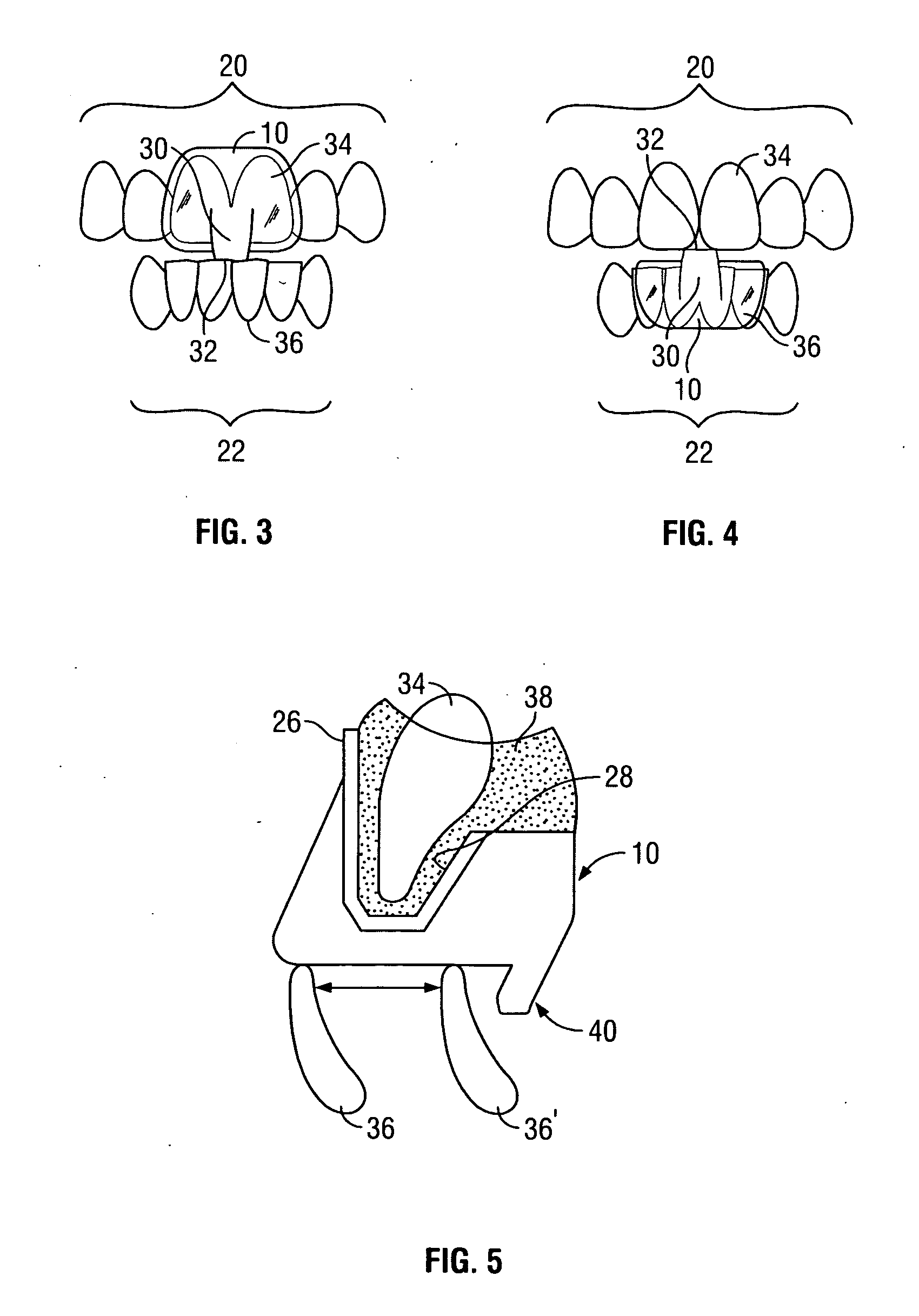 Intraoral discluder and method for relieving migraine and tension headaches and temporomandibular disorders