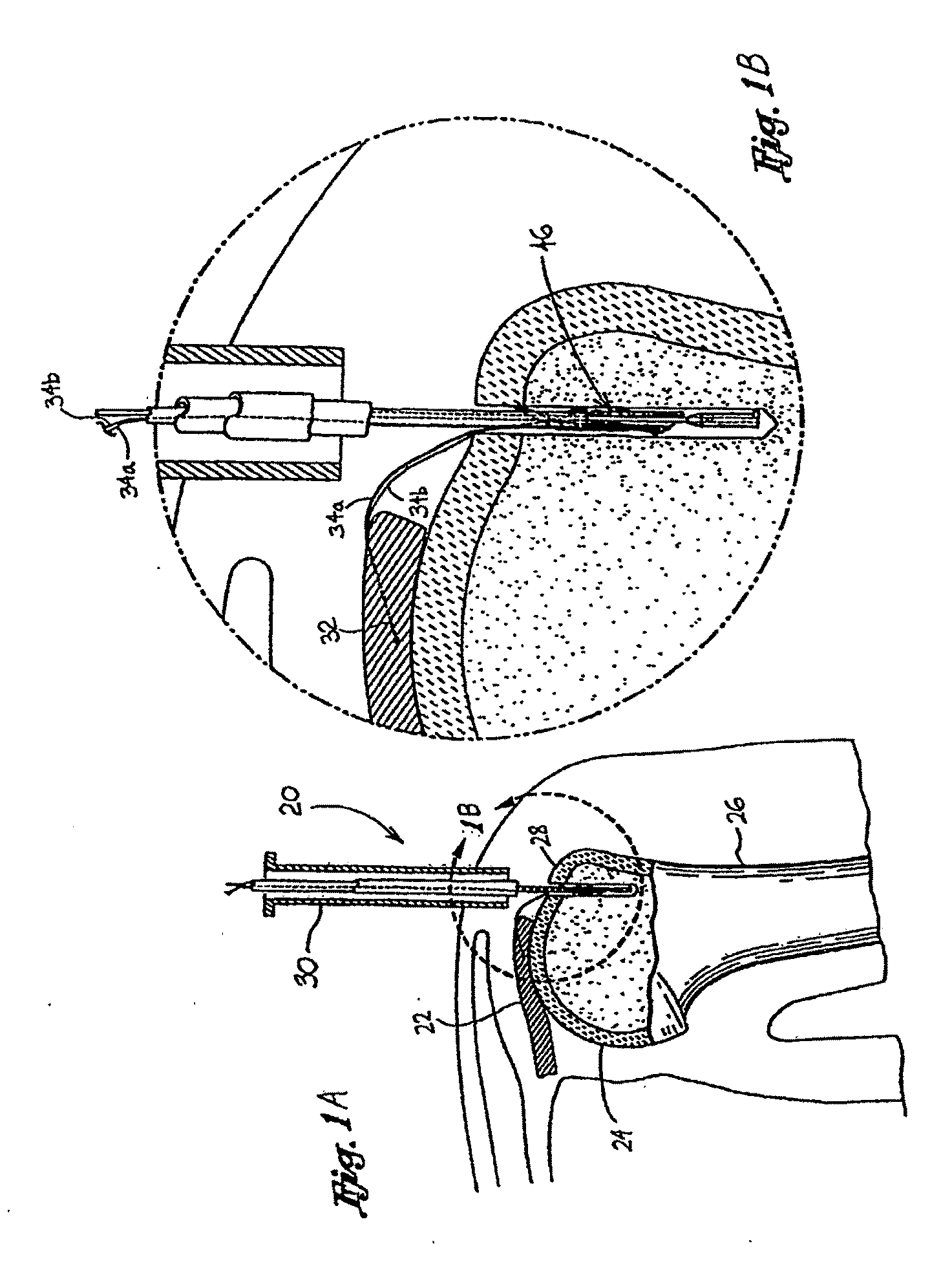 Knotless suture anchoring device having deforming section to accommodate sutures of various diameters