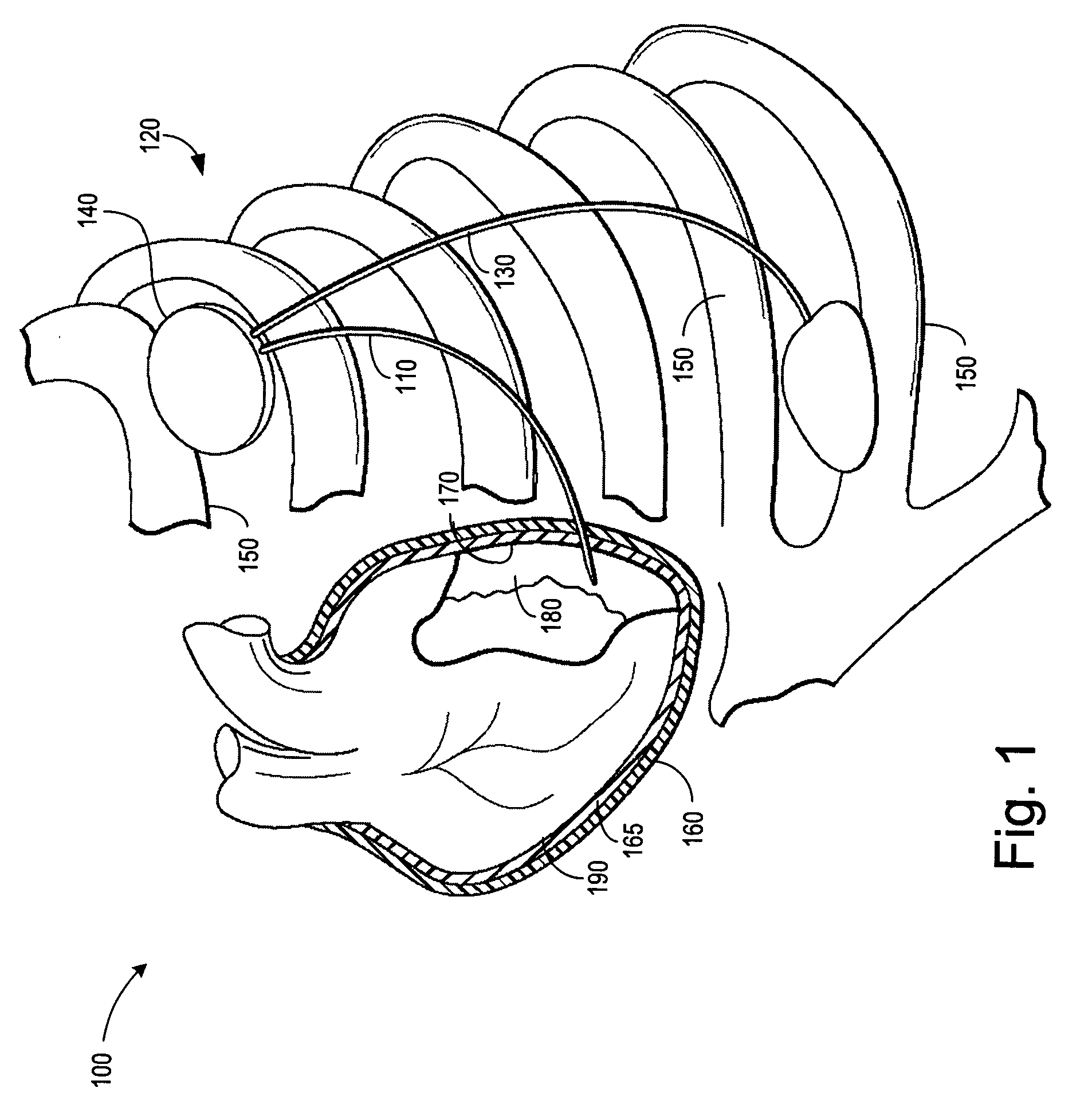 Cardiac lead having coated fixation arrangement