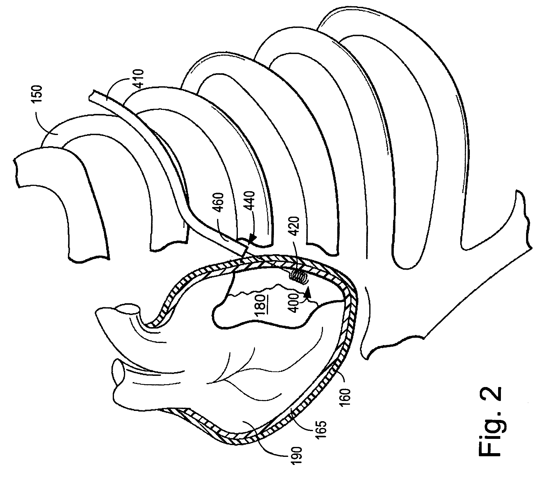 Cardiac lead having coated fixation arrangement