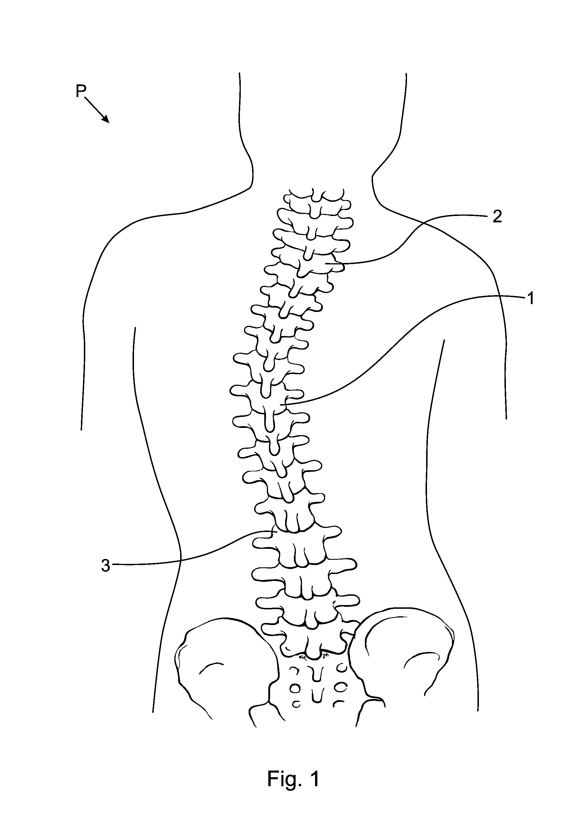 Subcutaneous implantable device for gradually aligning a spine and subcutaneous implantable device for gradually lengthening a bone