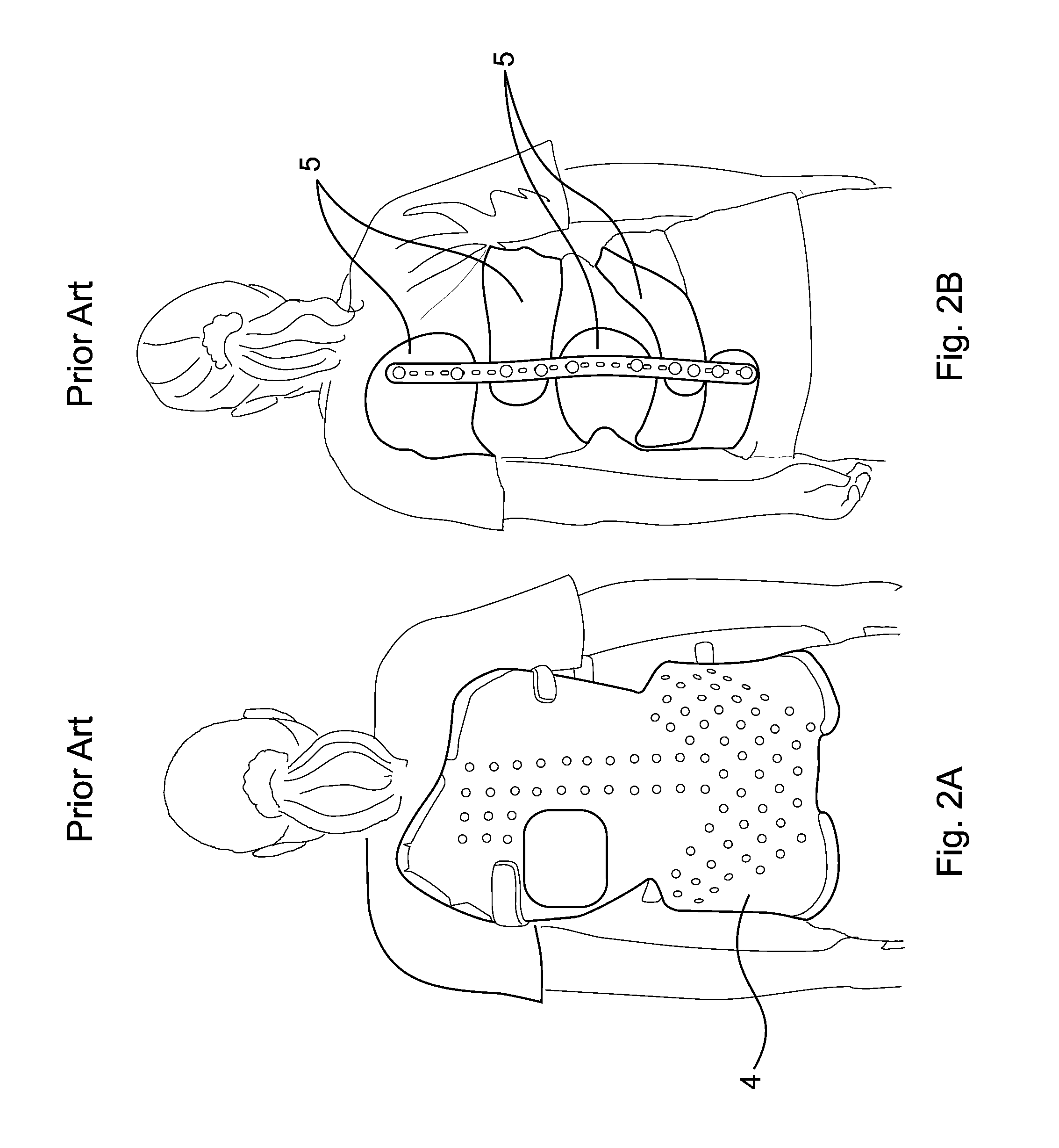 Subcutaneous implantable device for gradually aligning a spine and subcutaneous implantable device for gradually lengthening a bone