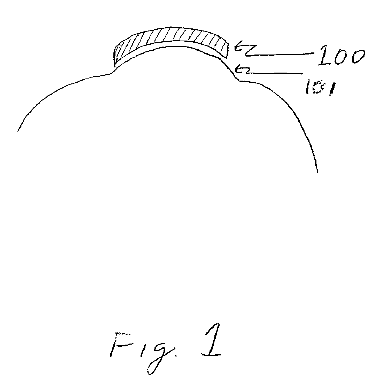 Apparatus and method for removing epithelium from the cornea