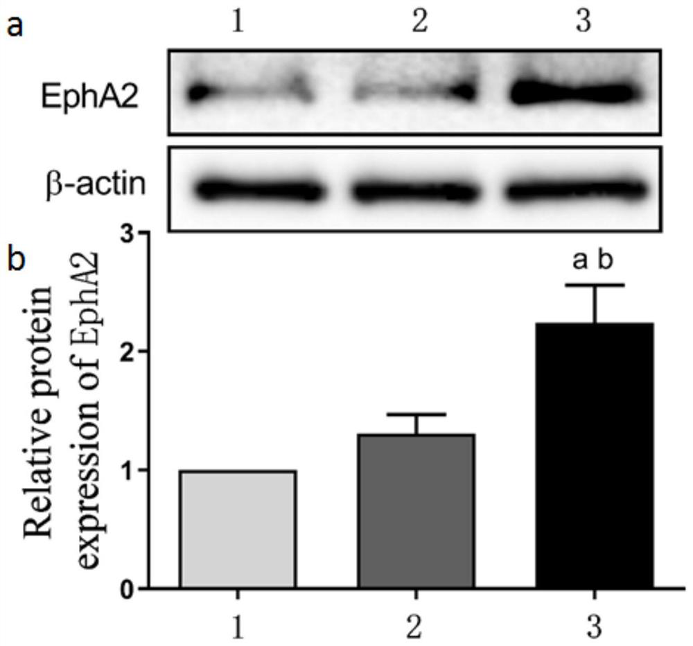 Application of EphA2 gene in preparation of product for treating or diagnosing breast cancer caused by pyroptosis-related protein