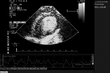 Method for establishing coronary artery microvascular spasm pig-model