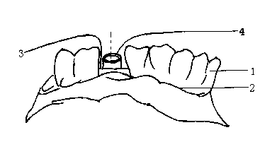 Method for preparing positioning guide plate of oral and dental implants