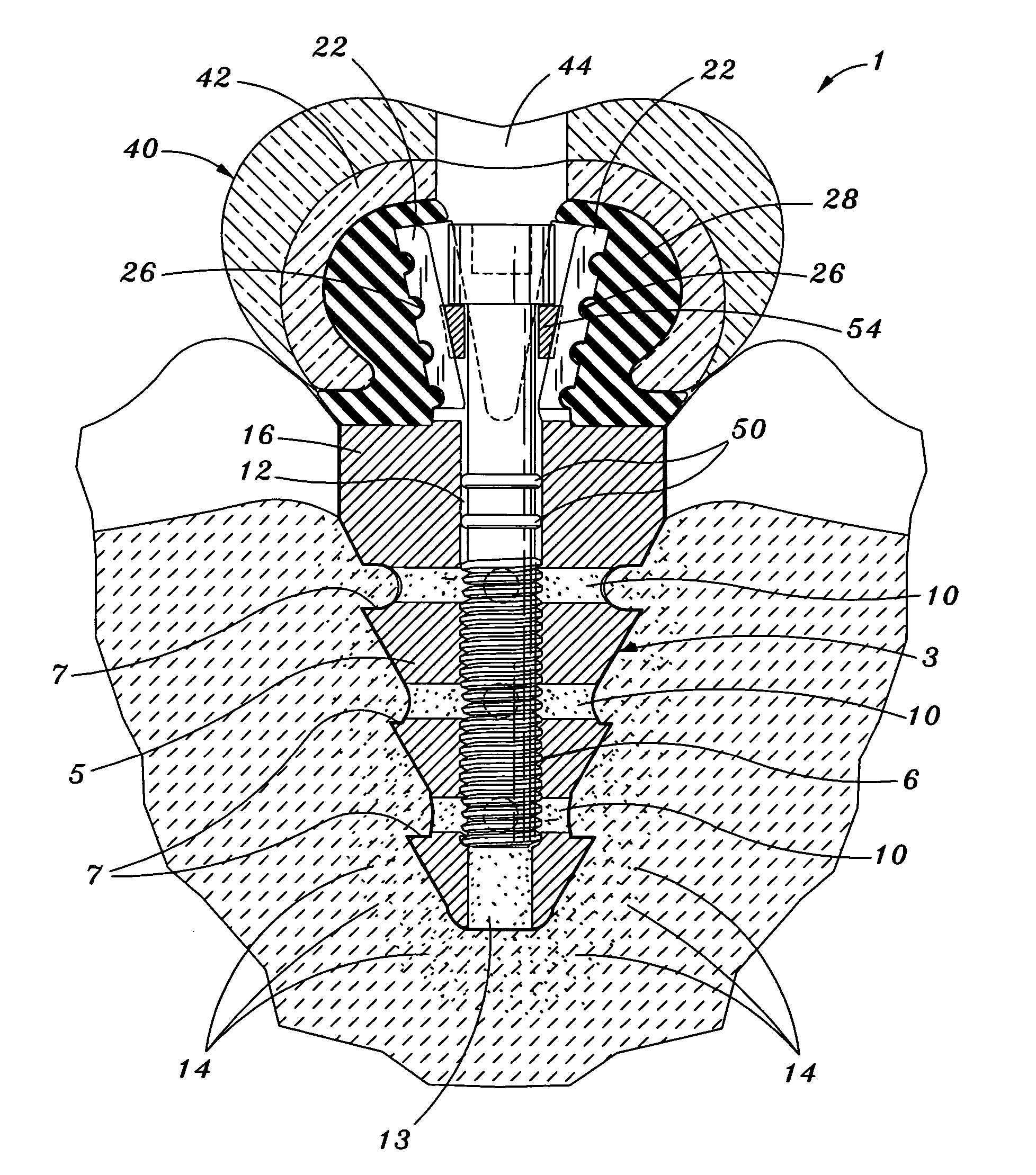 Biofunctional dental implant