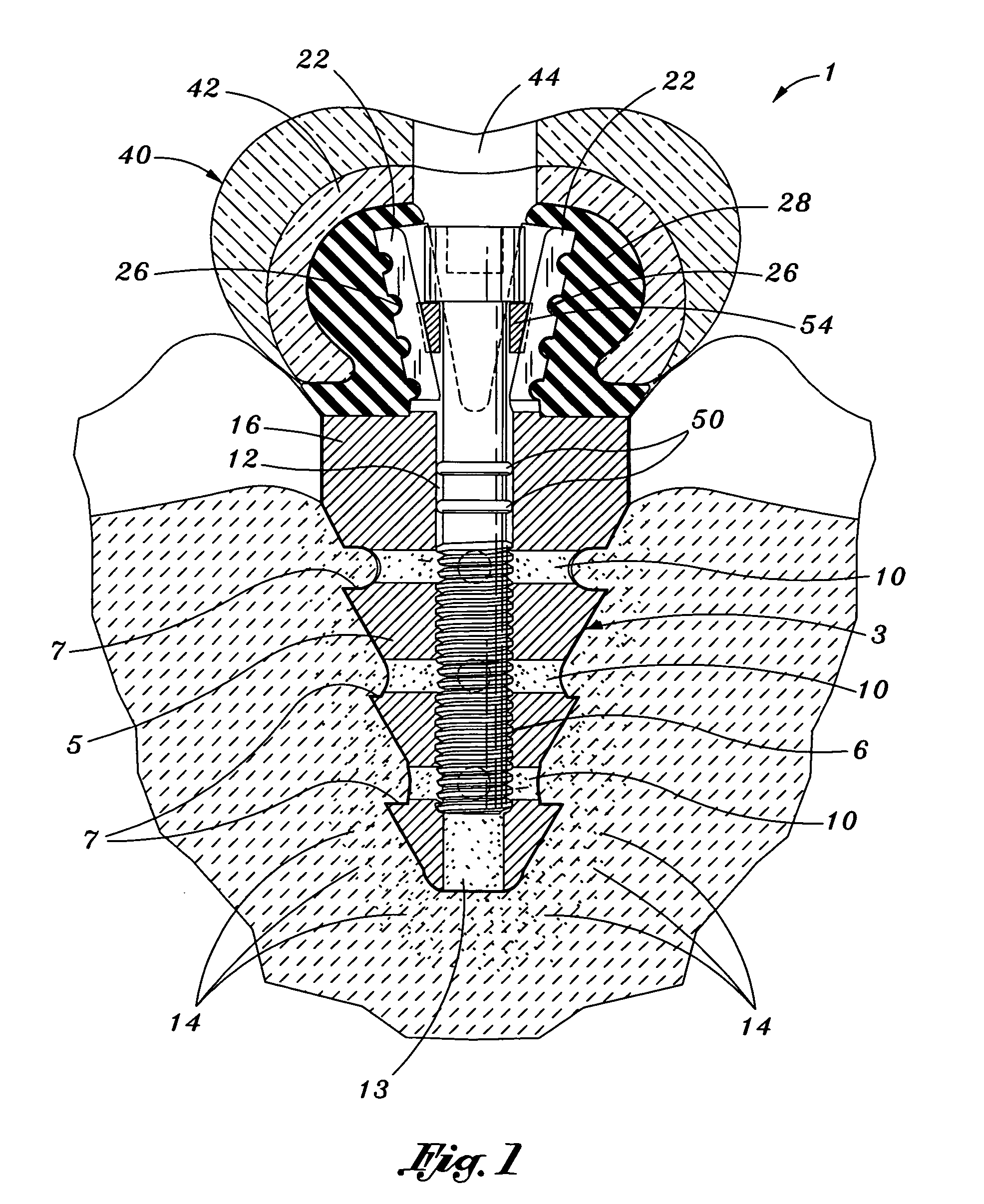 Biofunctional dental implant