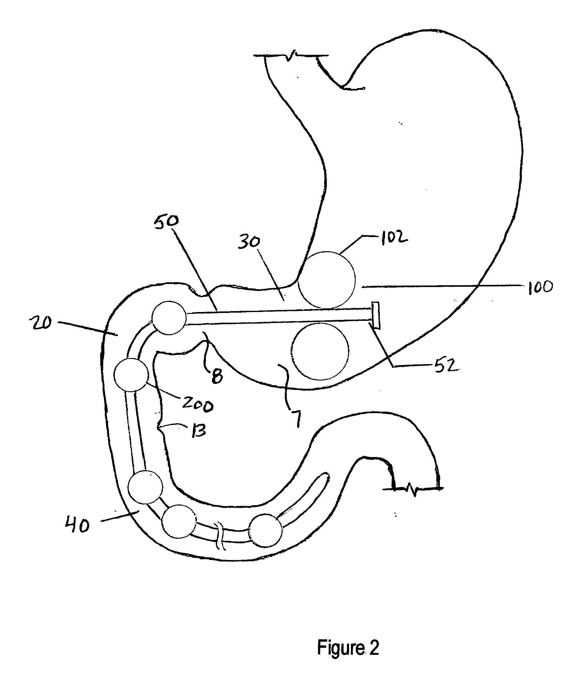 Method and apparatus for reducing obesity