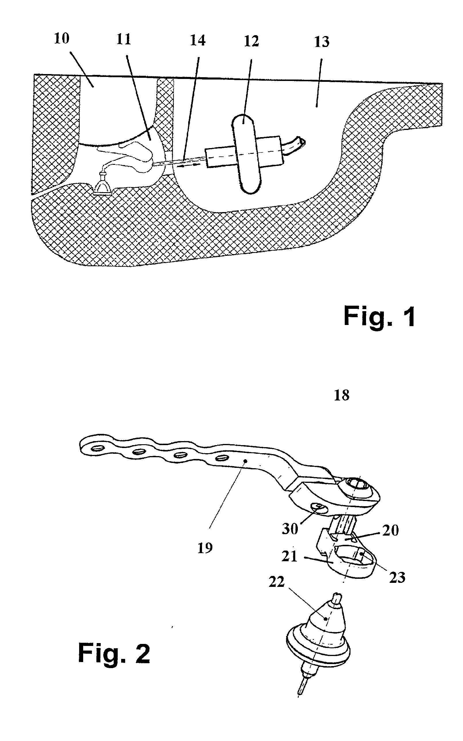 At least partially implantable hearing system