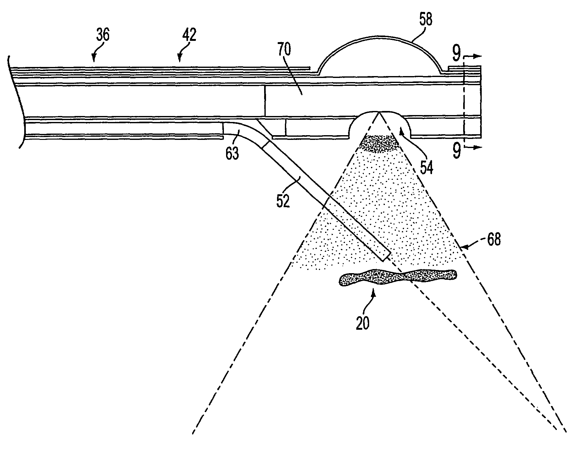 Devices and methods for occlusion of the uterine arteries