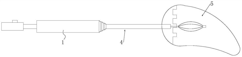 Continuous expanding type fascia dilator for percutaneous nephroscope surgery