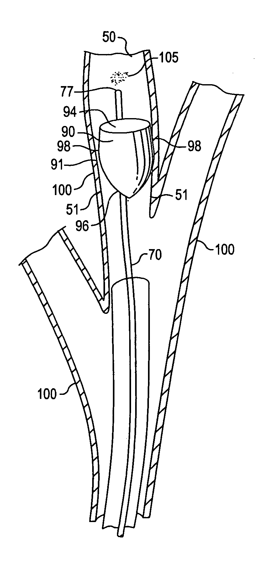 Device and method for intra-bronchial provision of a therapeutic agent