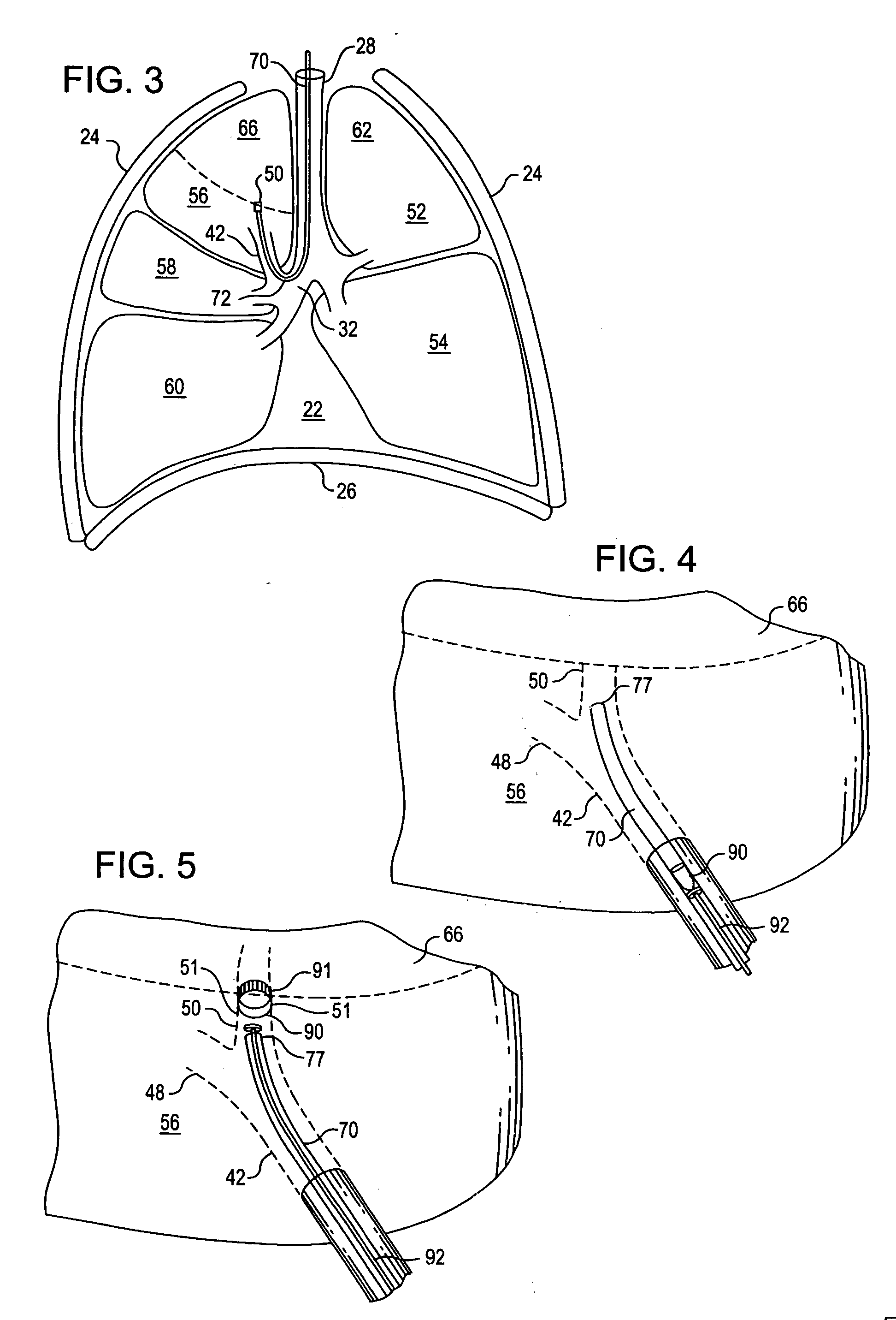 Device and method for intra-bronchial provision of a therapeutic agent